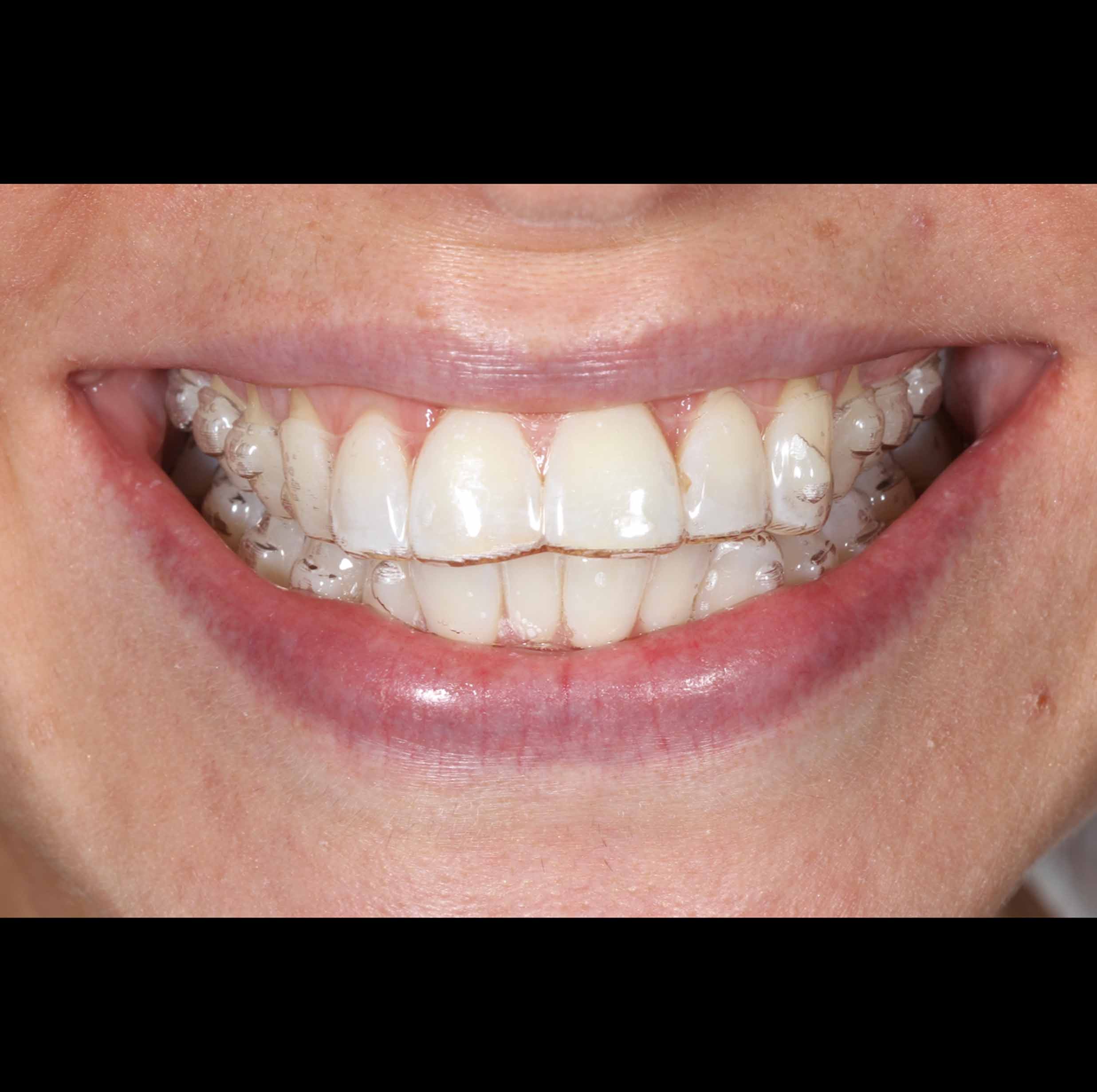 before and after photo of Invisalign and teeth whitening treatment for adults