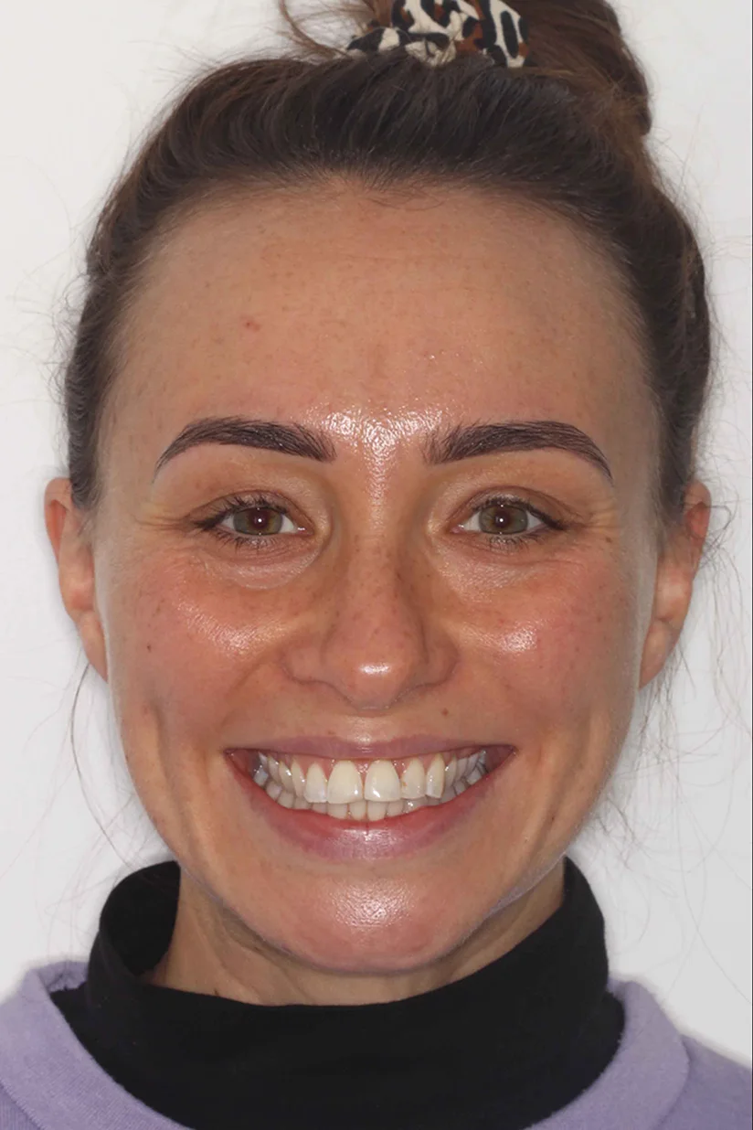 before and after photo of Invisalign and teeth whitening treatment for adults