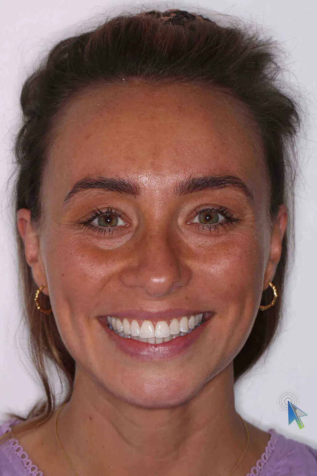 before and after photo of Invisalign and teeth whitening treatment for adults