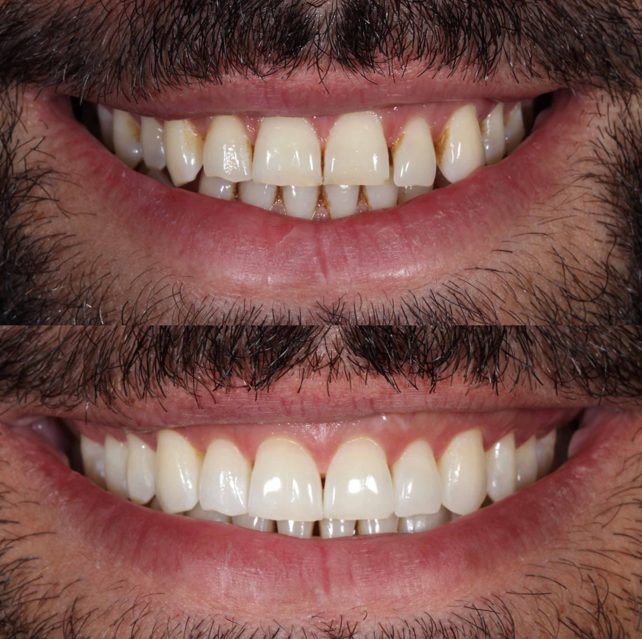 before and after photo of Invisalign and teeth whitening treatment for adults