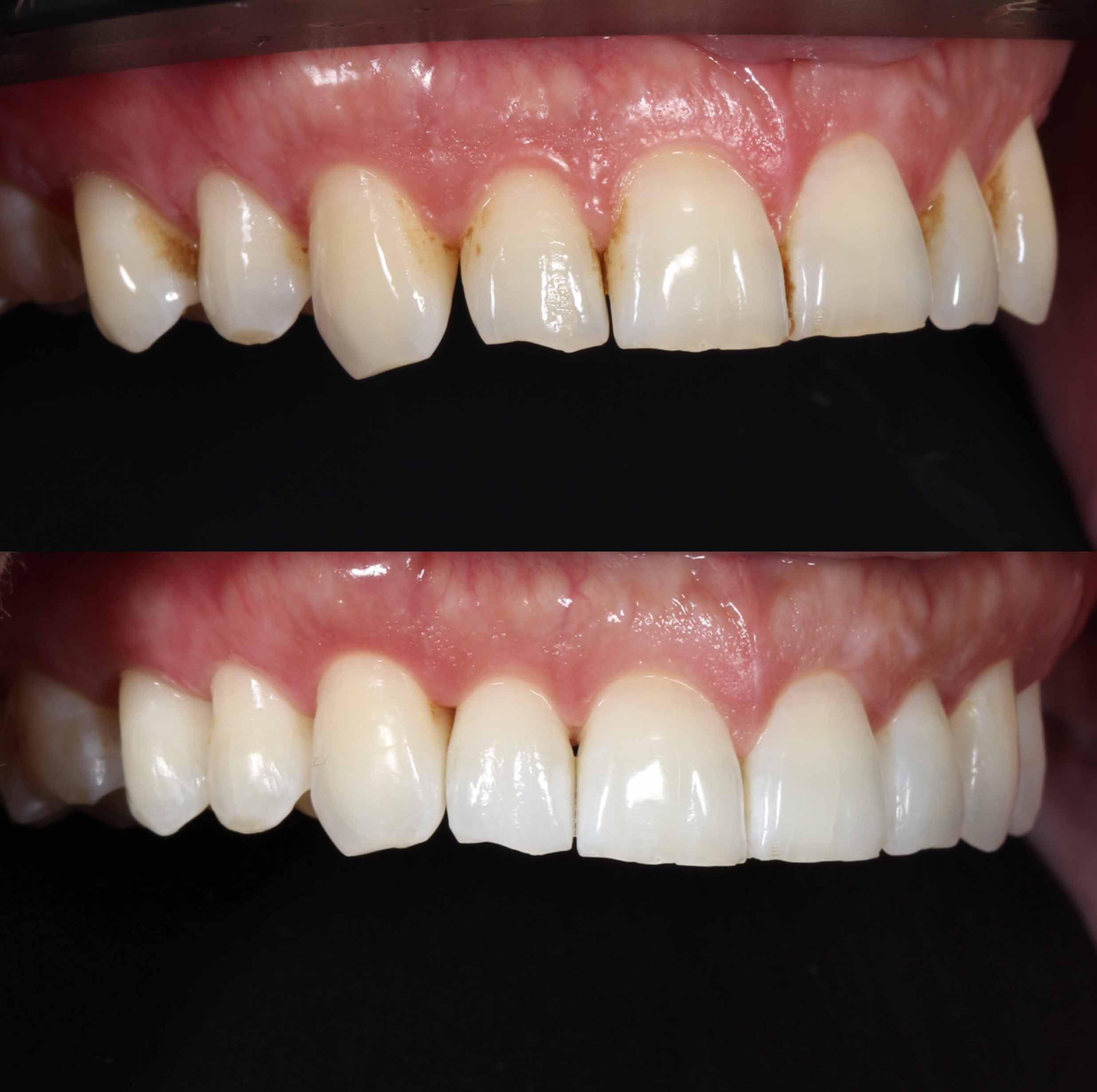 before and after photo of Invisalign and teeth whitening treatment for adults