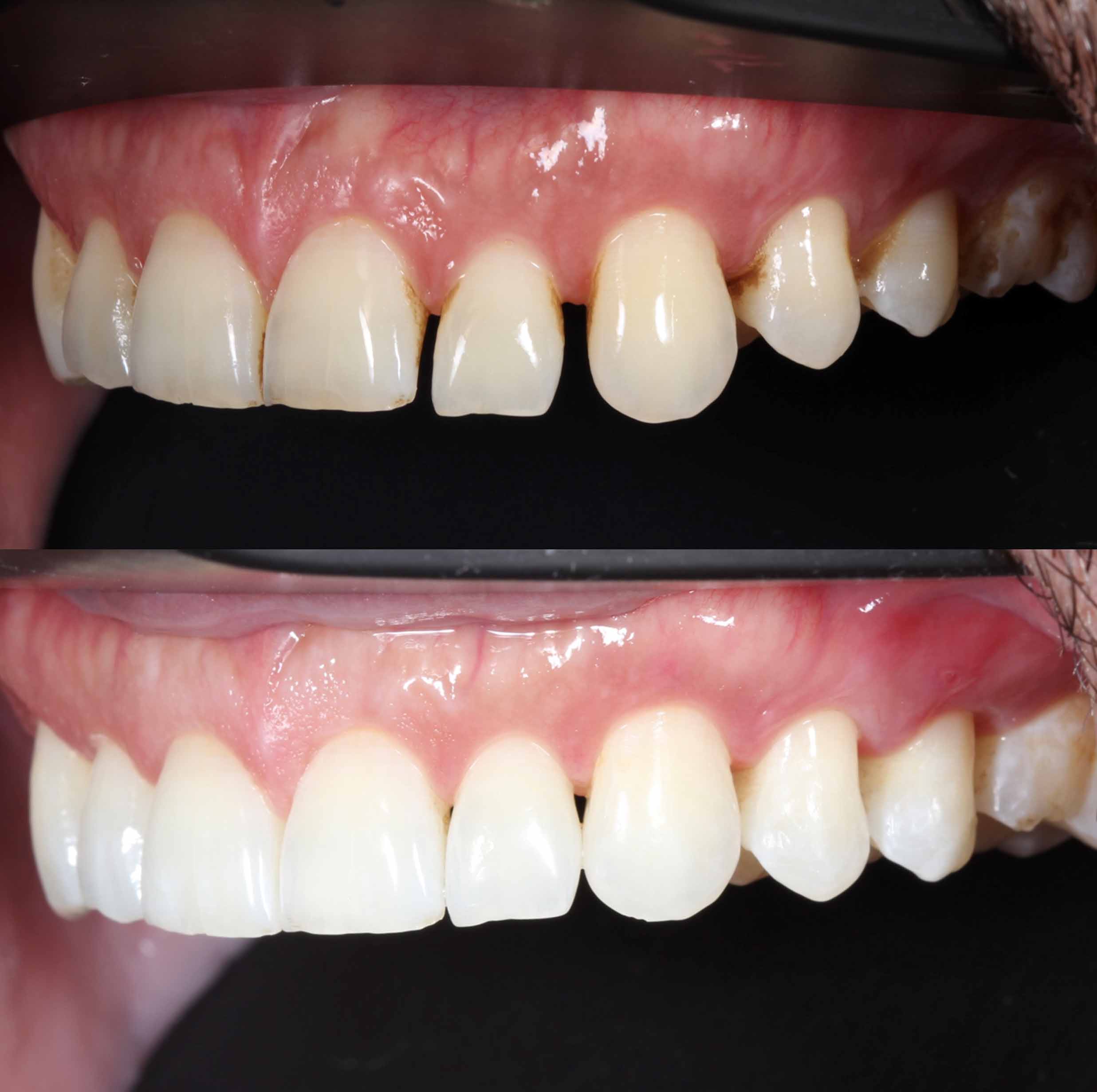 before and after photo of Invisalign and teeth whitening treatment for adults