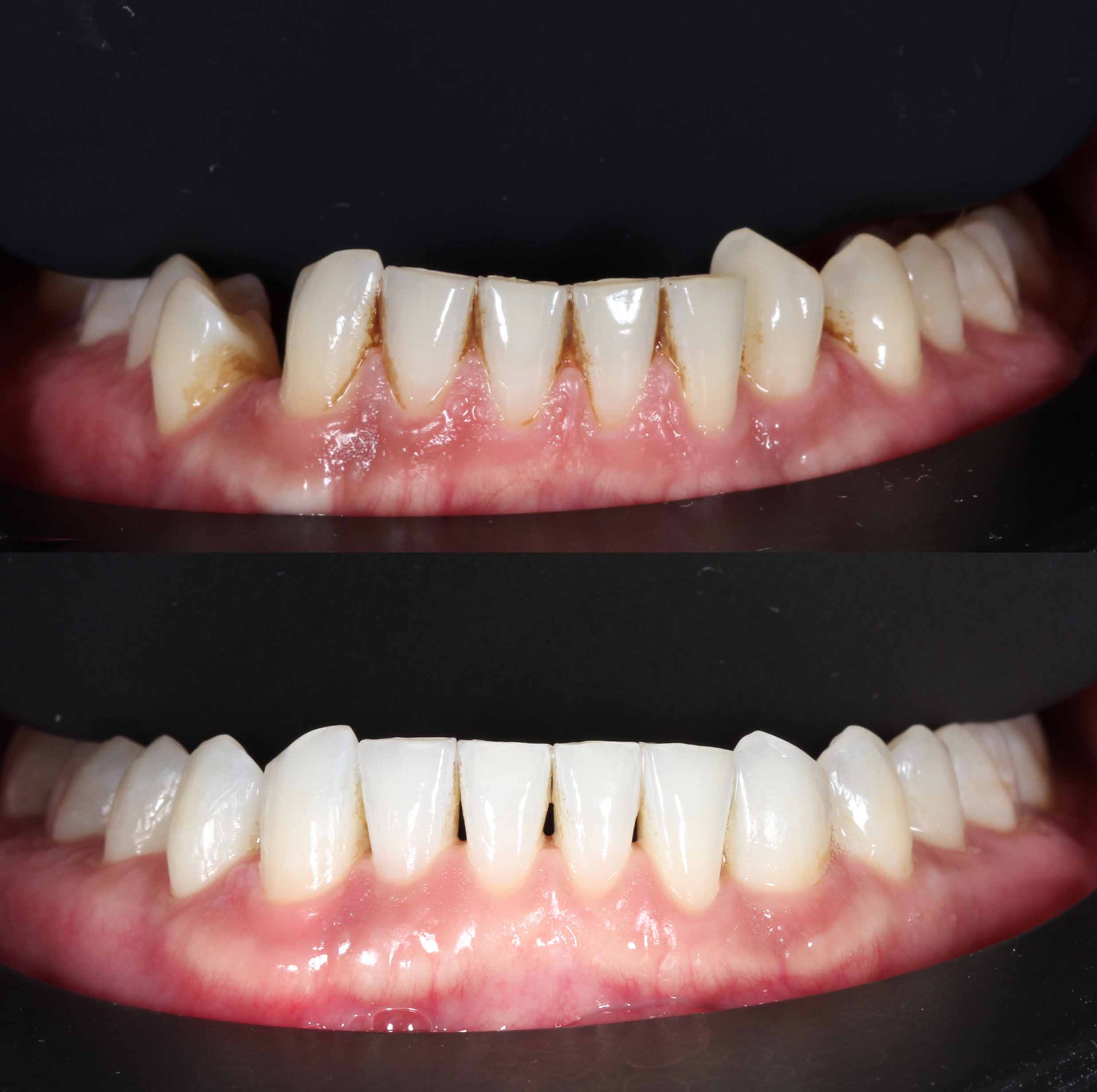 before and after photo of Invisalign and teeth whitening treatment for adults