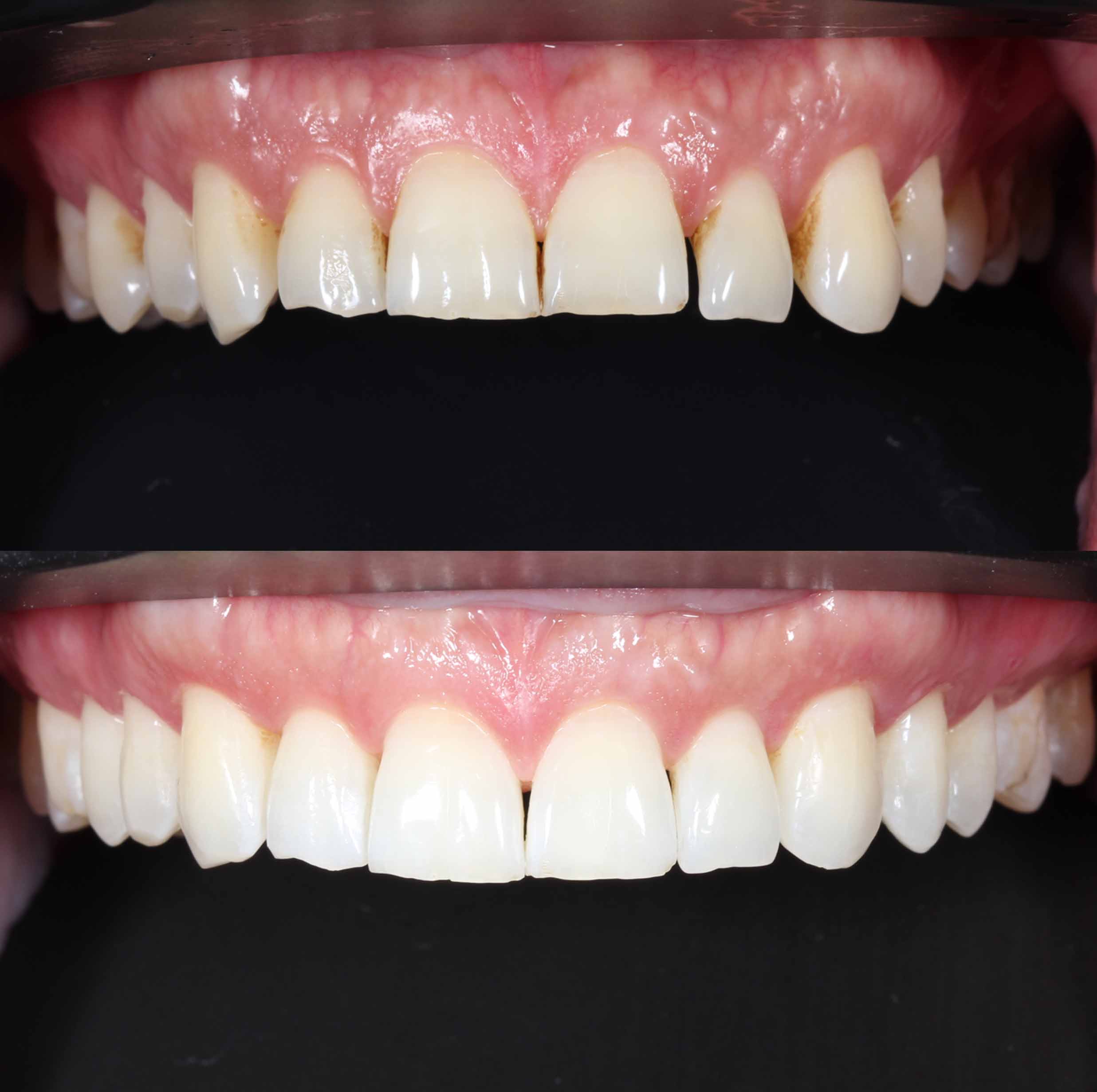 before and after photo of Invisalign and teeth whitening treatment for adults