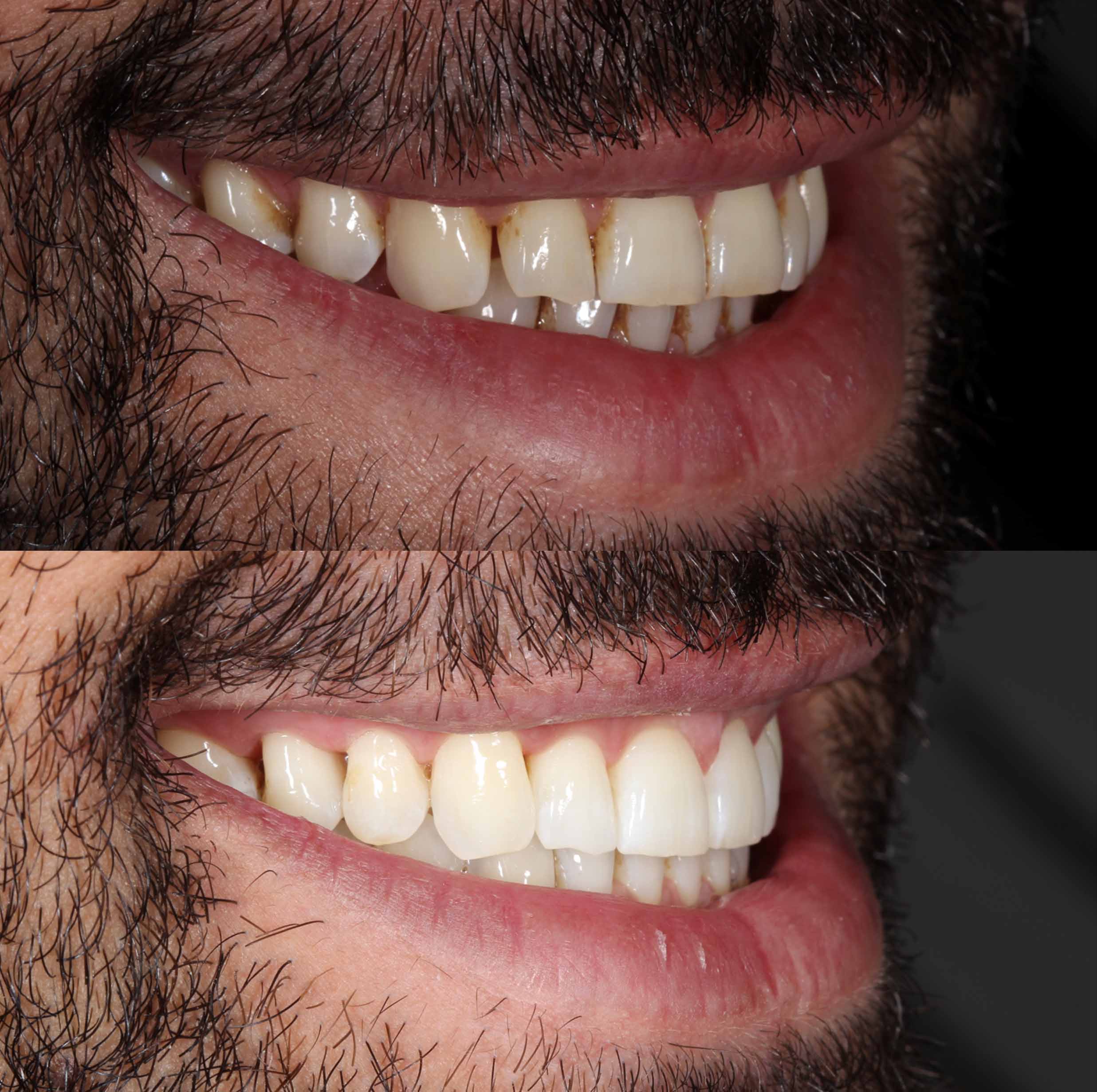 before and after photo of Invisalign and teeth whitening treatment for adults