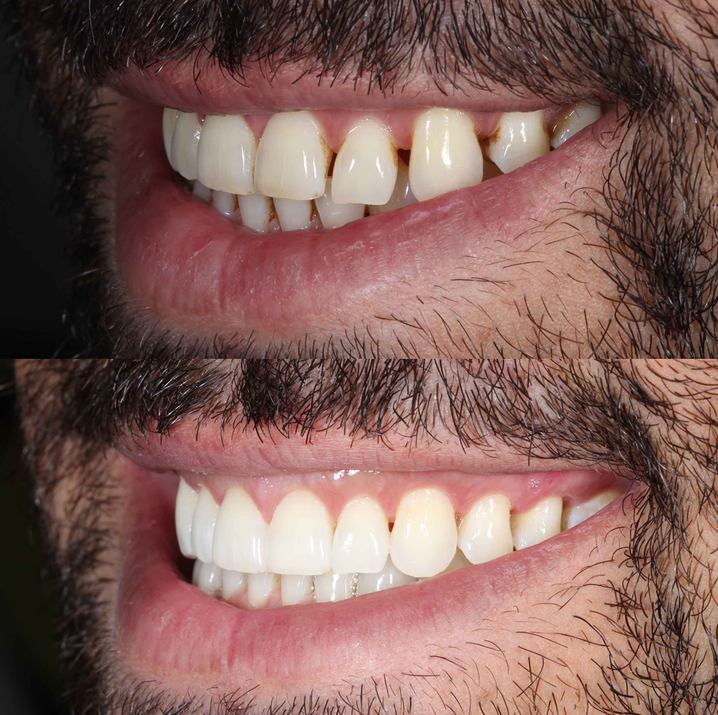 before and after photo of Invisalign and teeth whitening treatment for adults