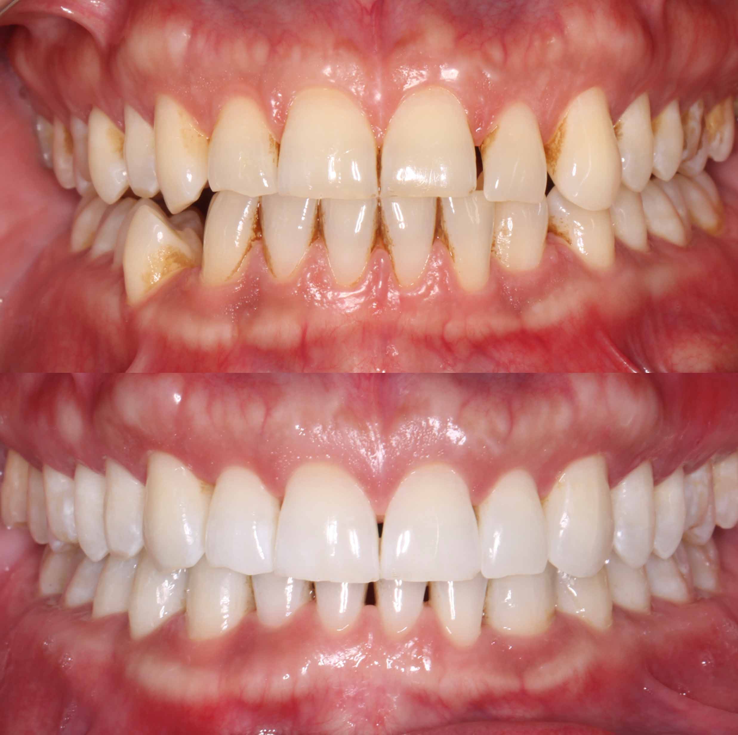 before and after photo of Invisalign and teeth whitening treatment for adults
