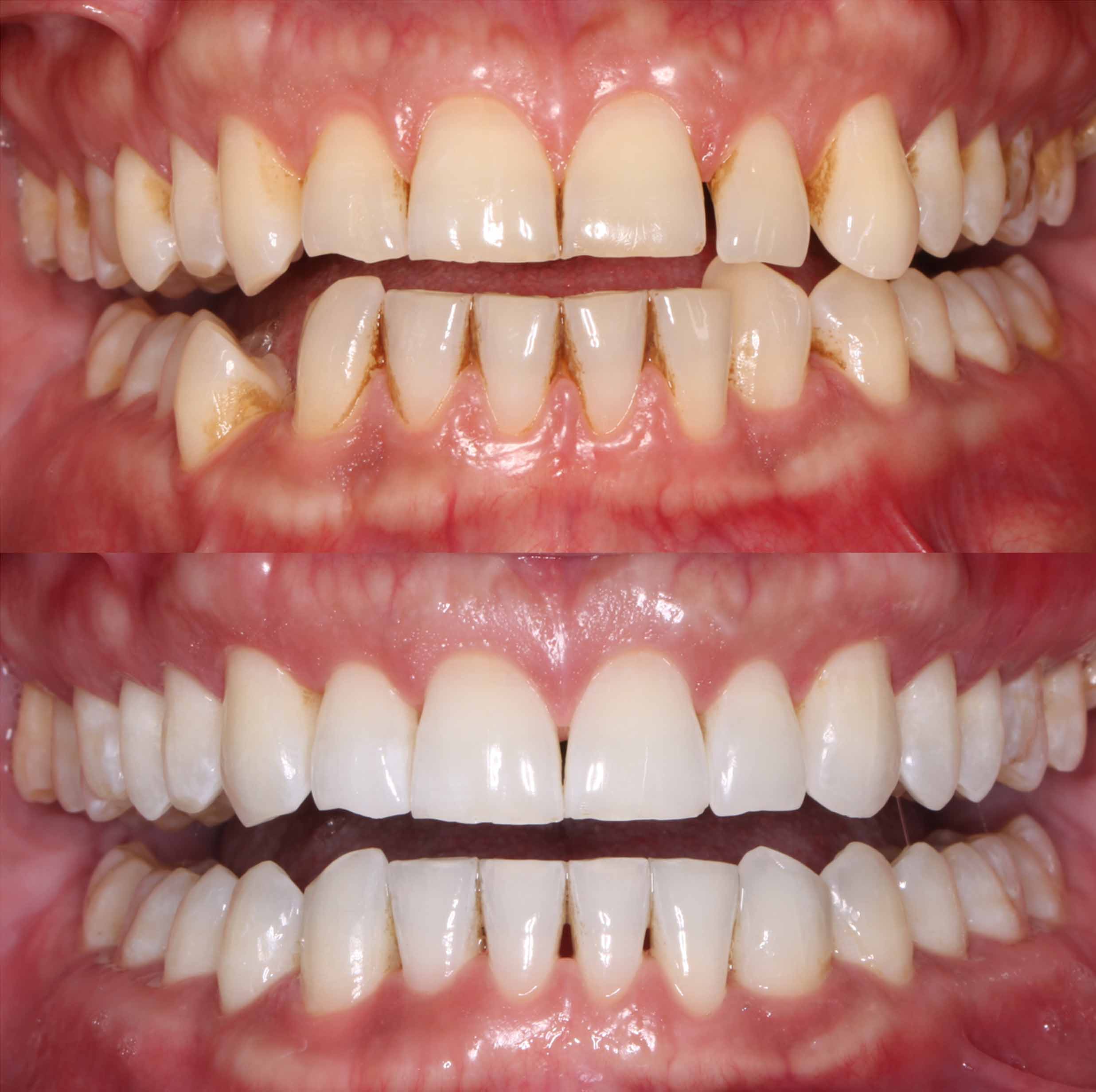 before and after photo of Invisalign and teeth whitening treatment for adults