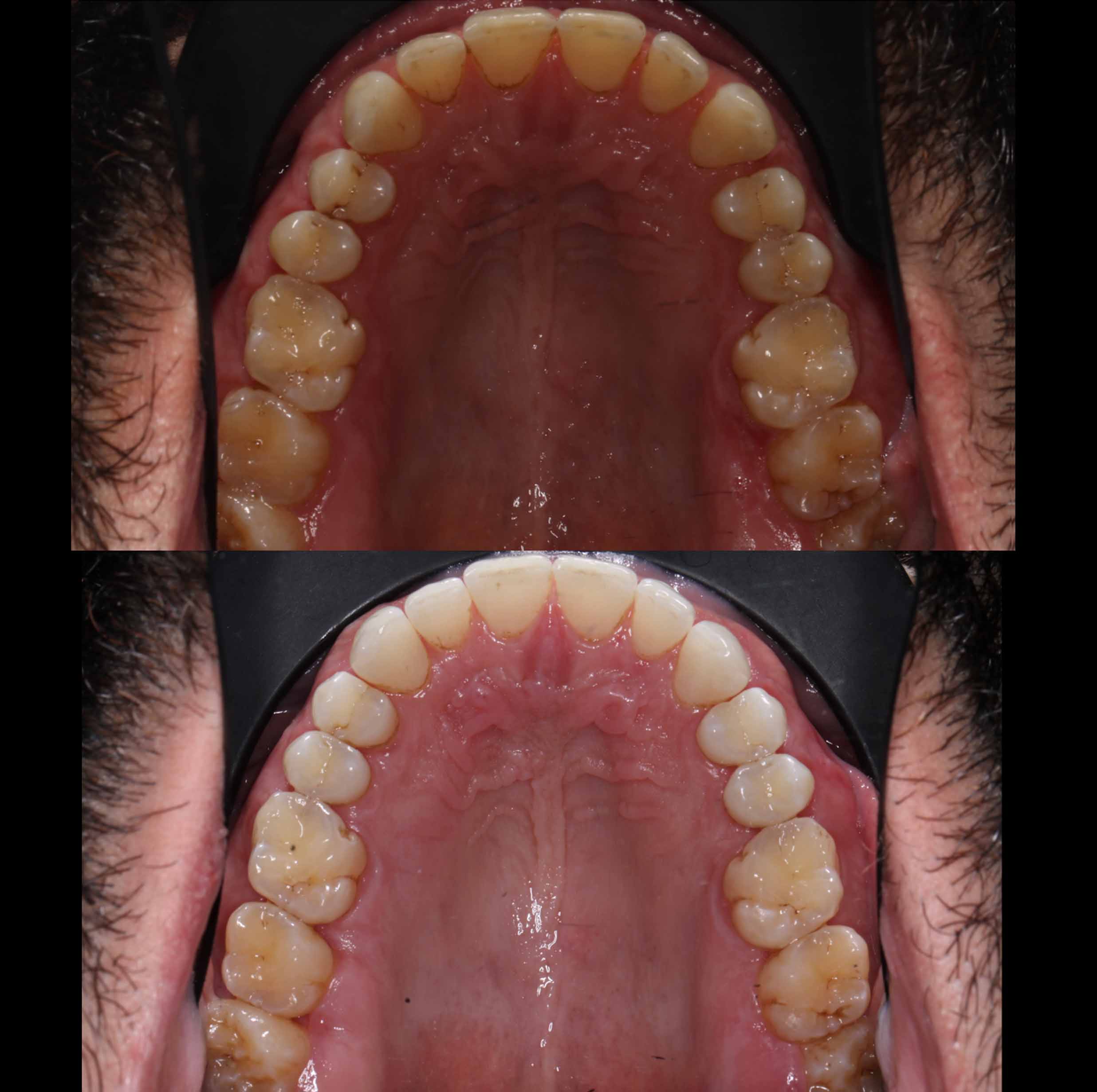 before and after photo of Invisalign and teeth whitening treatment for adults