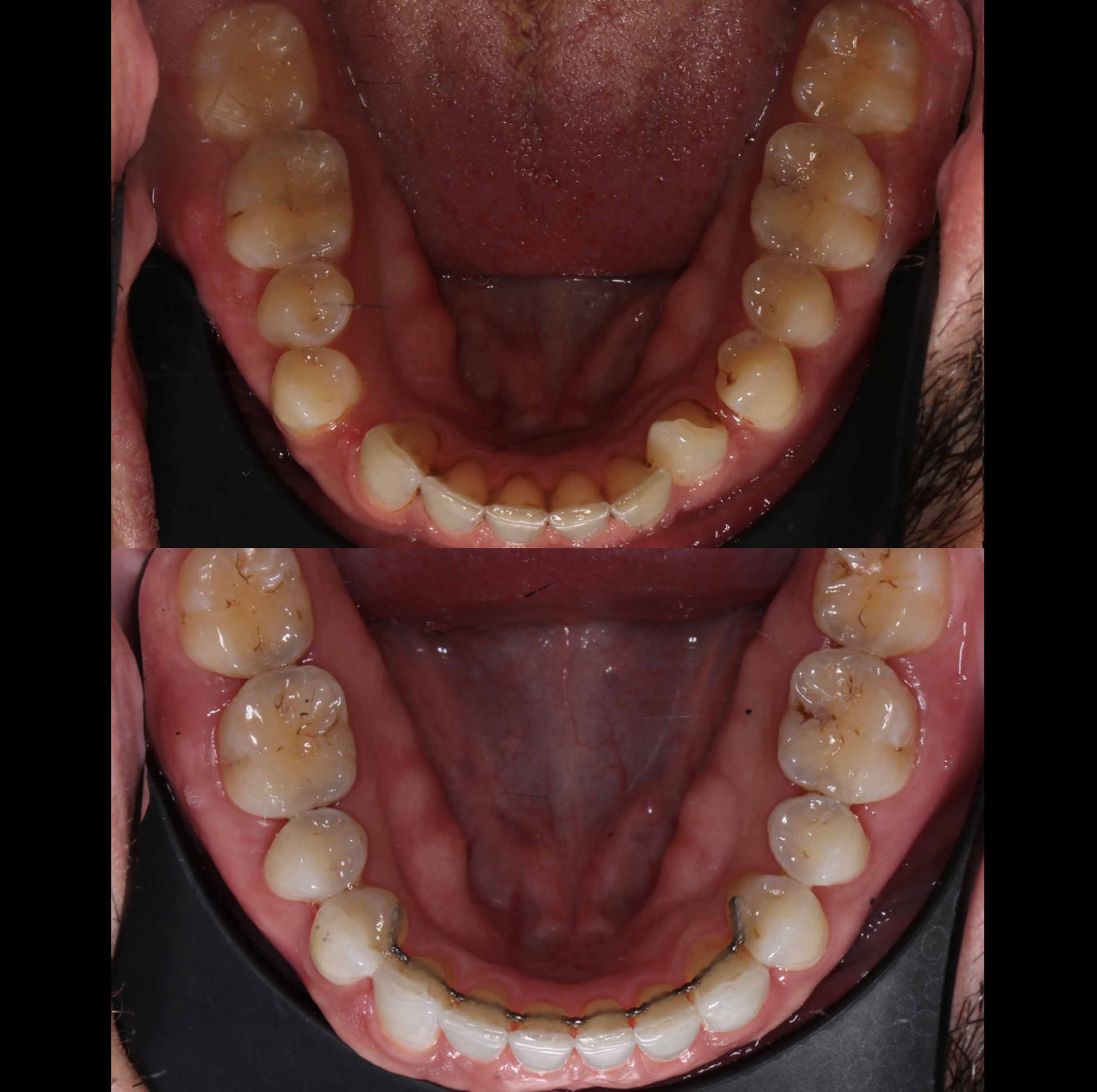 before and after photo of Invisalign and teeth whitening treatment for adults