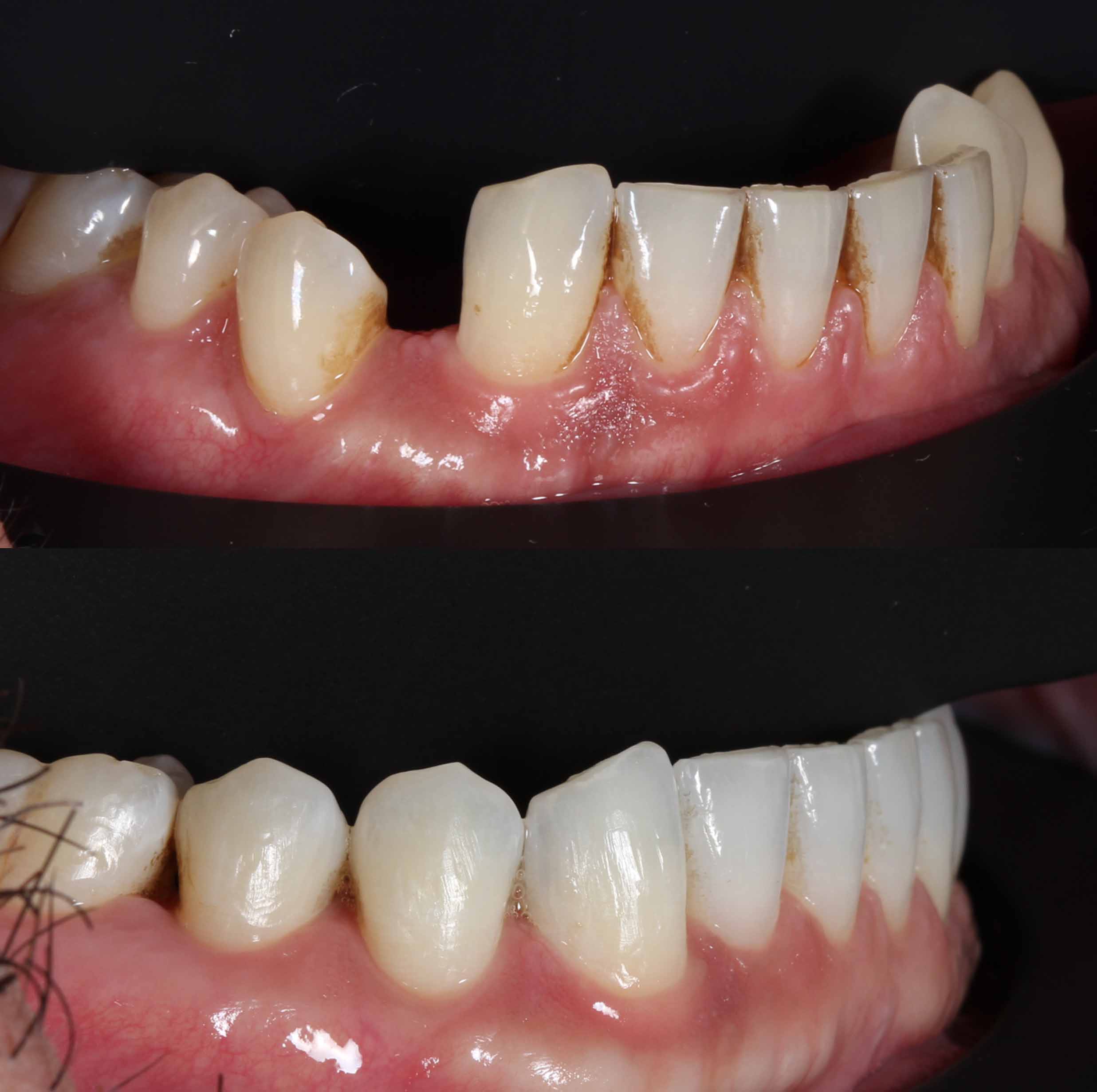 before and after photo of Invisalign and teeth whitening treatment for adults