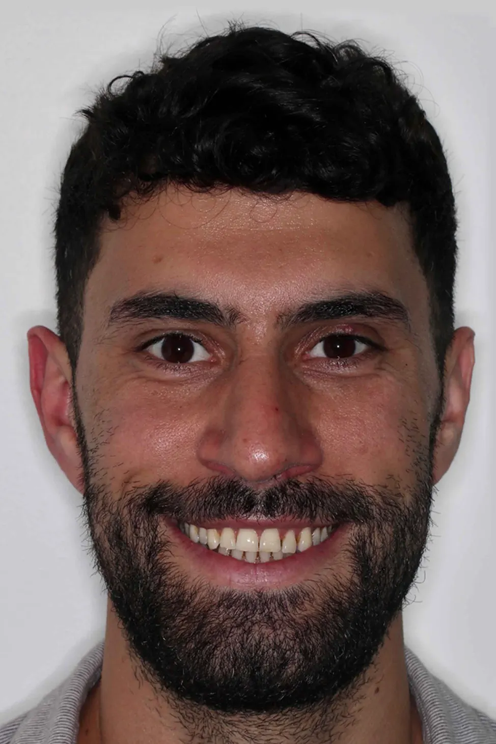 before and after photo of Invisalign and teeth whitening treatment for adults