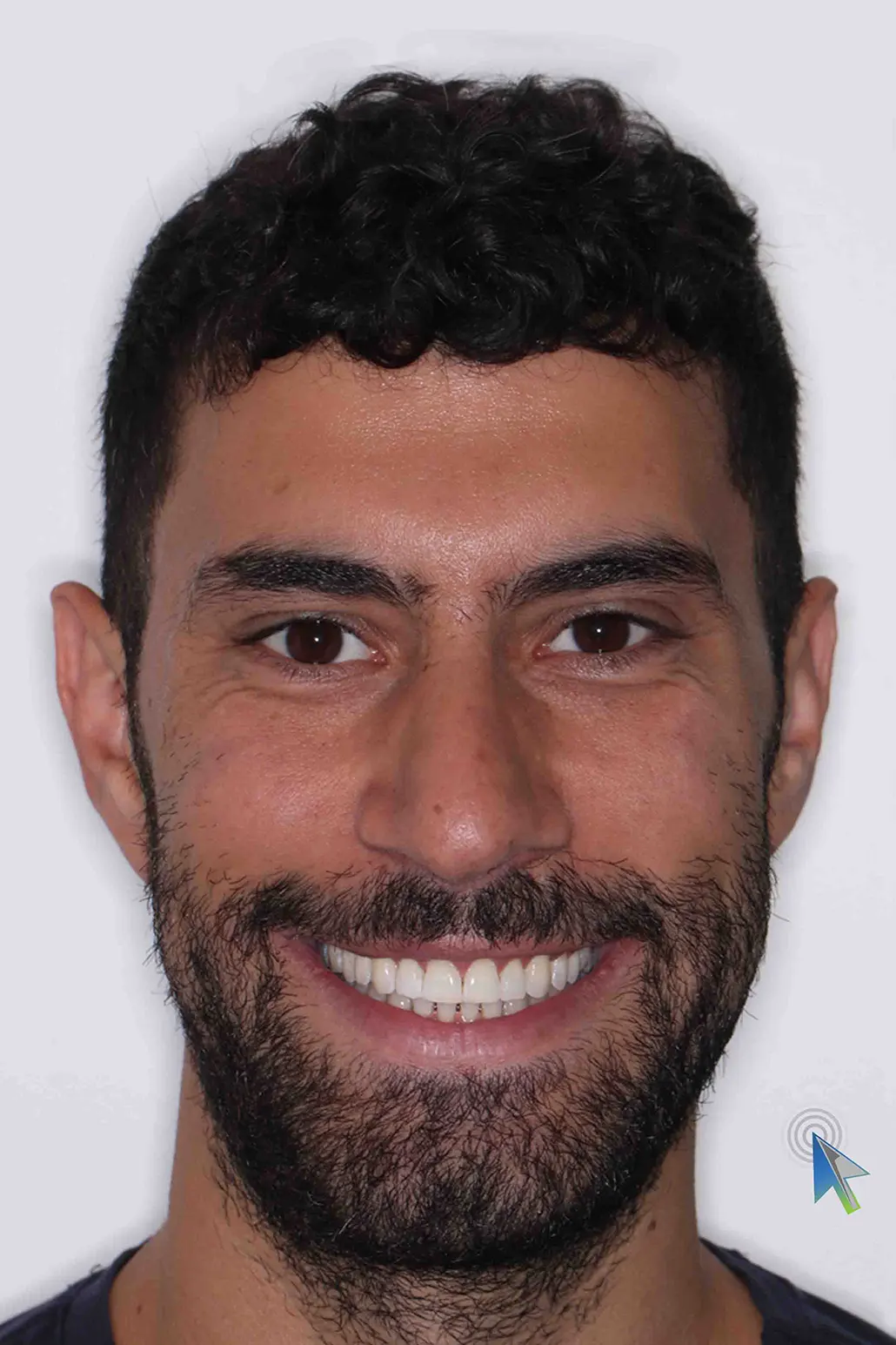 before and after photo of Invisalign and teeth whitening treatment for adults