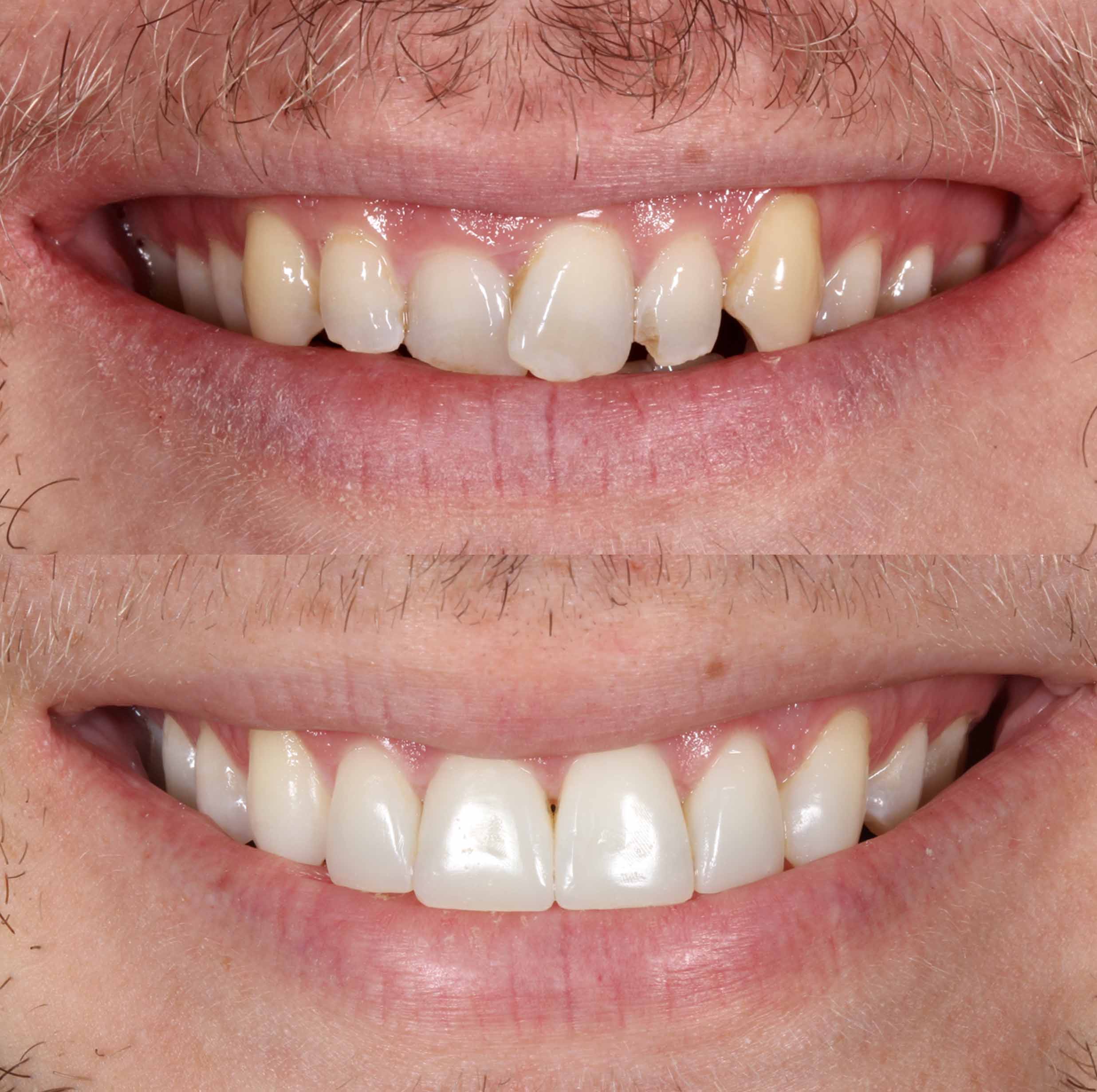 before and after photo of Invisalign, teeth whitening and SmileFast composite veneer treatment for adults