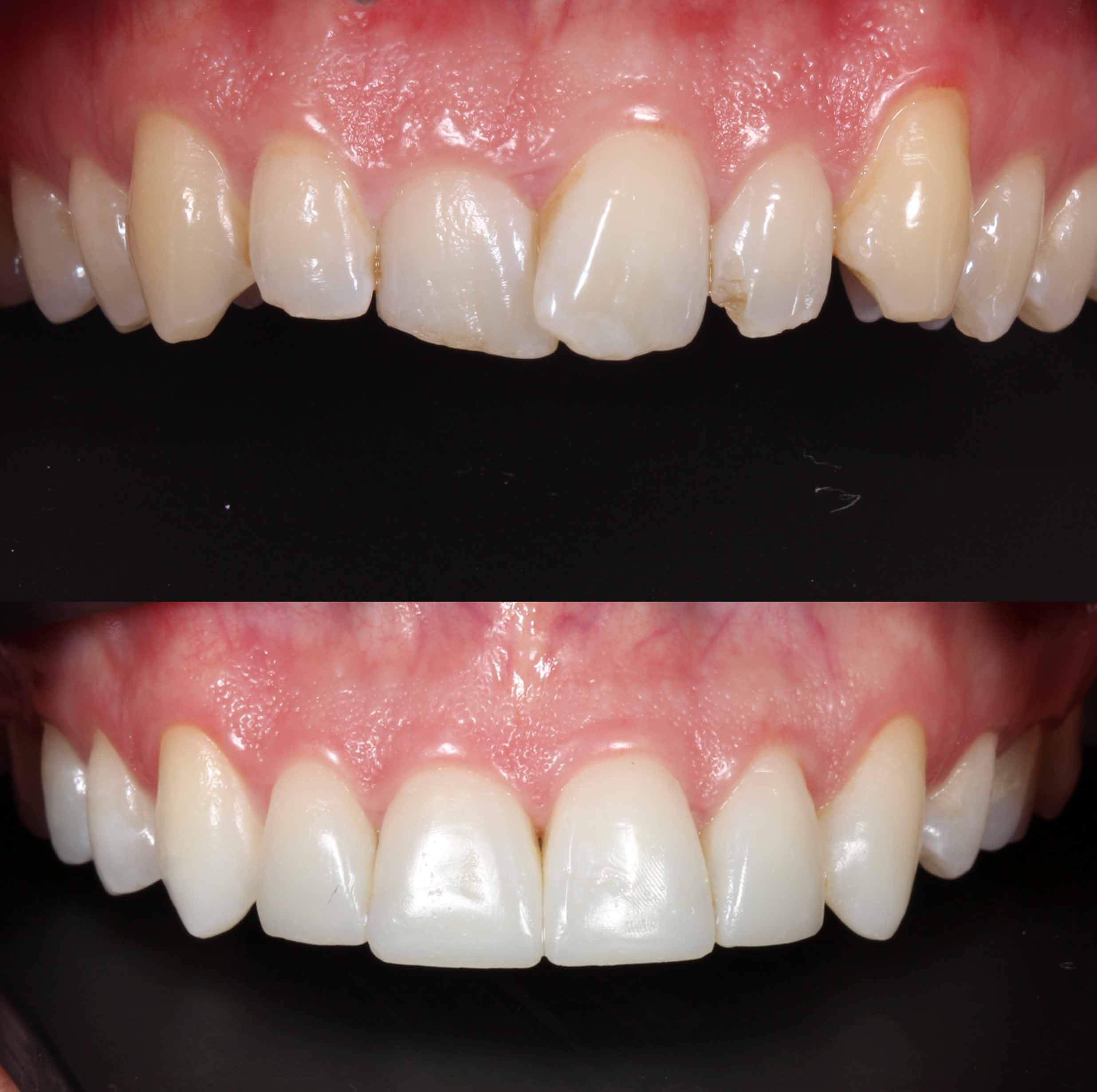 before and after photo of Invisalign, teeth whitening and SmileFast composite veneer treatment for adults