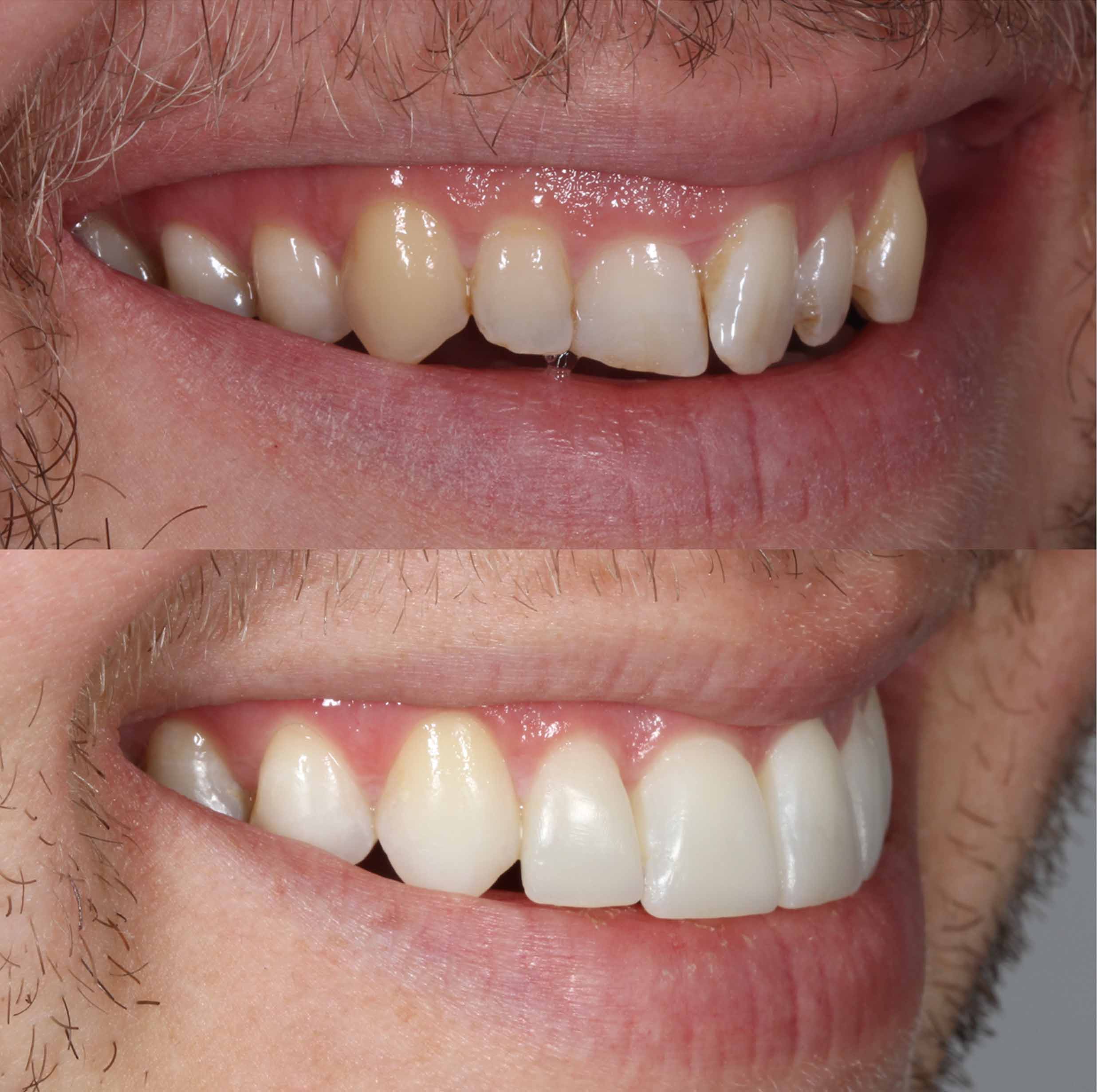 before and after photo of Invisalign, teeth whitening and SmileFast composite veneer treatment for adults