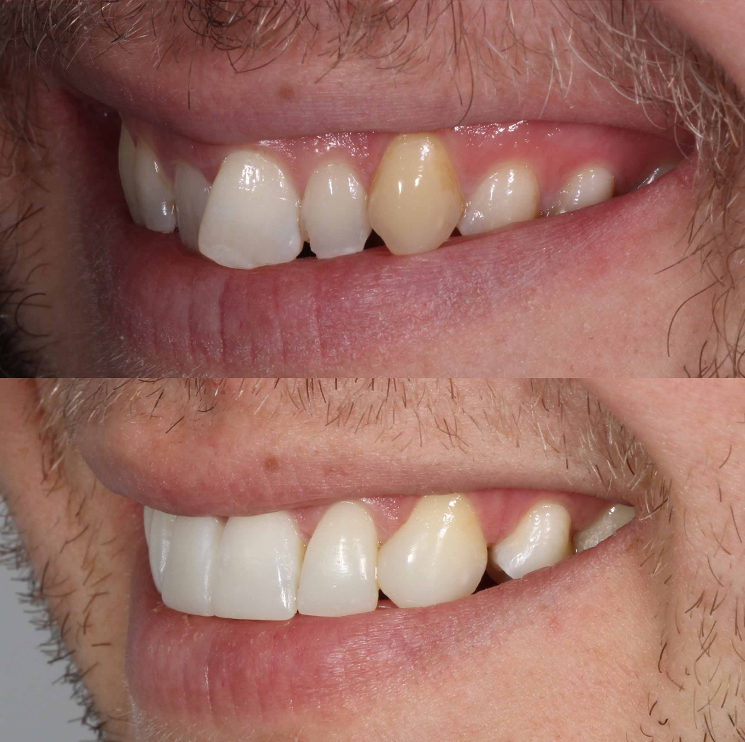 before and after photo of Invisalign, teeth whitening and SmileFast composite veneer treatment for adults