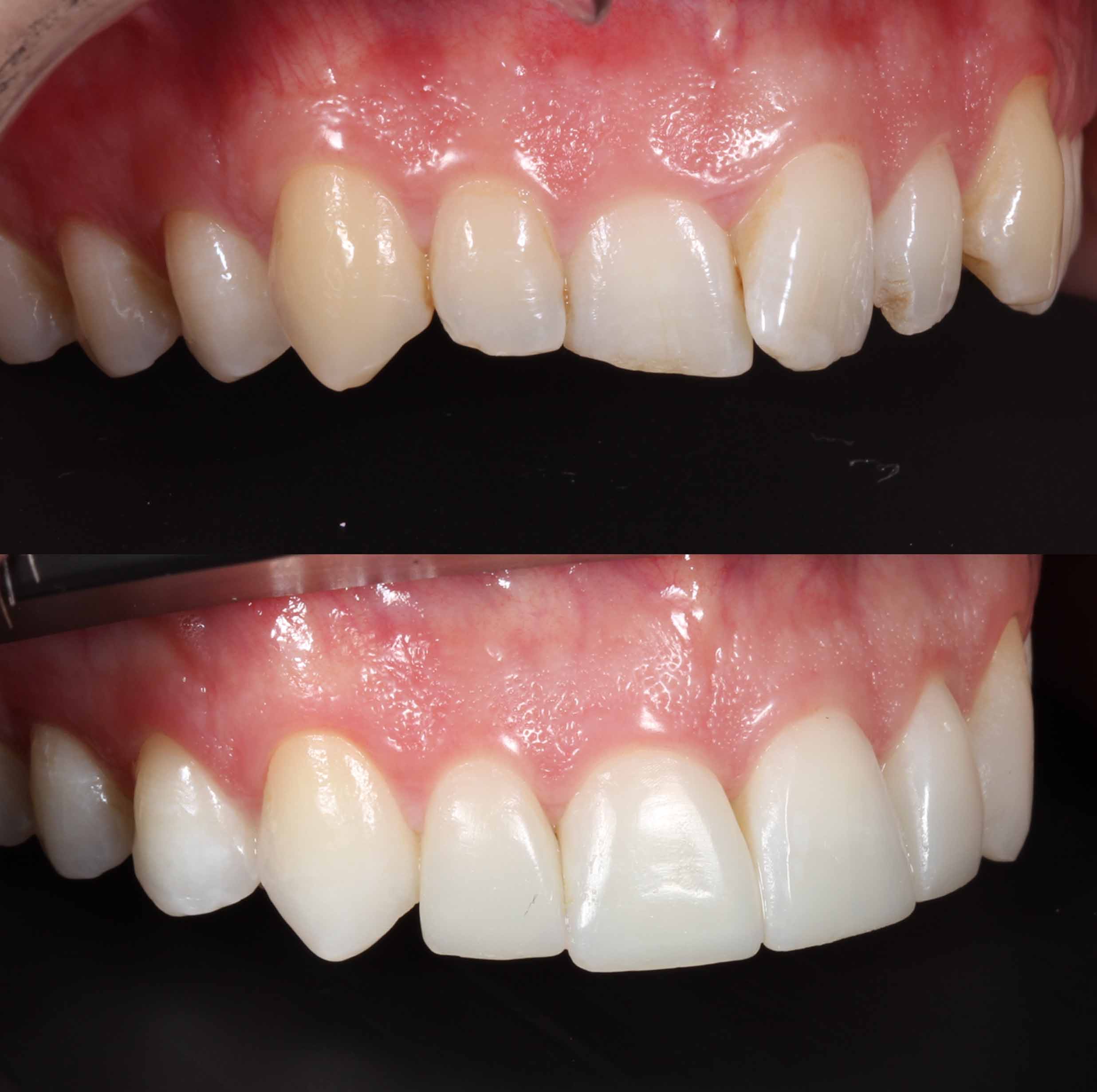 before and after photo of Invisalign, teeth whitening and SmileFast composite veneer treatment for adults