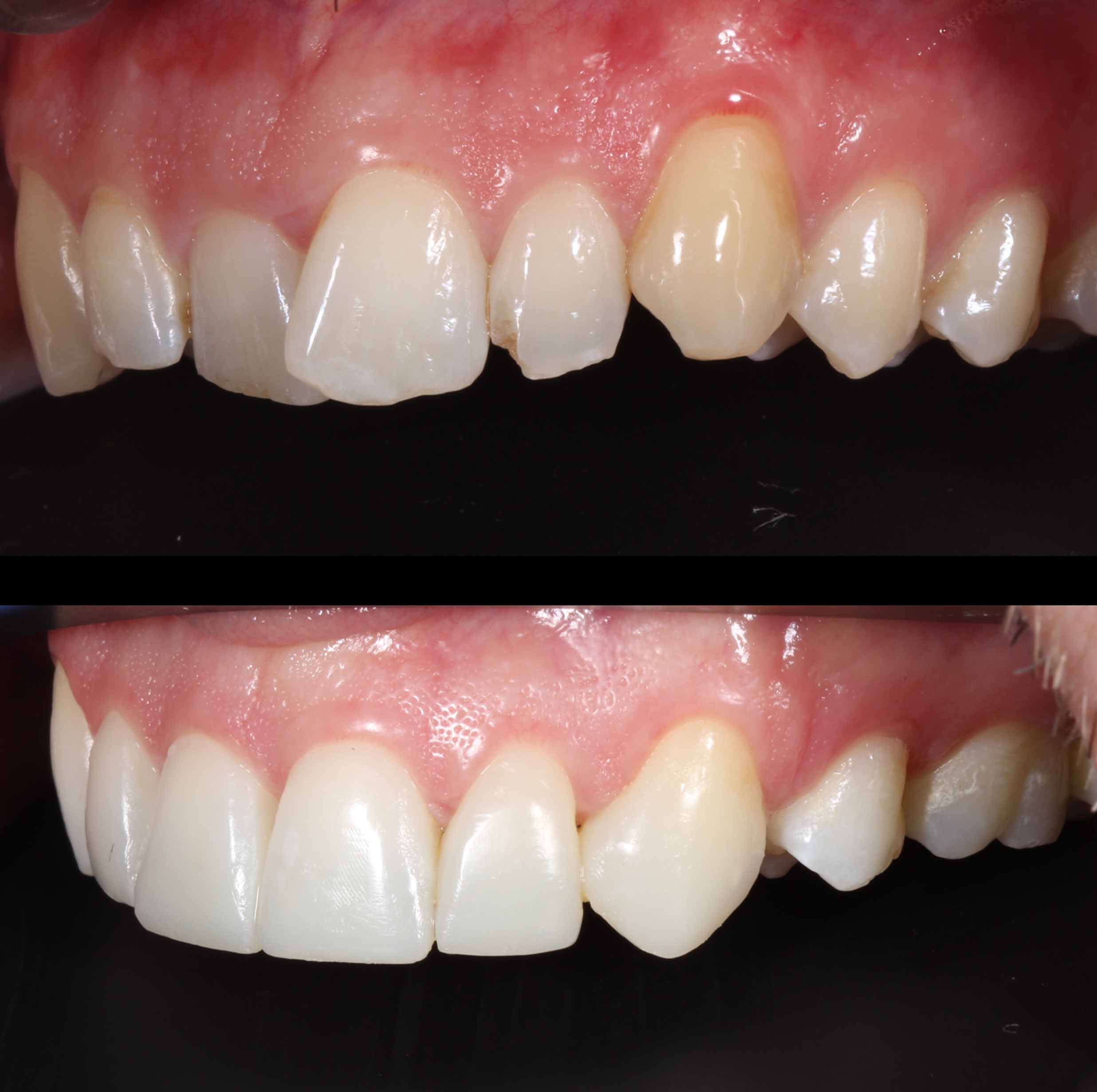 before and after photo of Invisalign, teeth whitening and SmileFast composite veneer treatment for adults