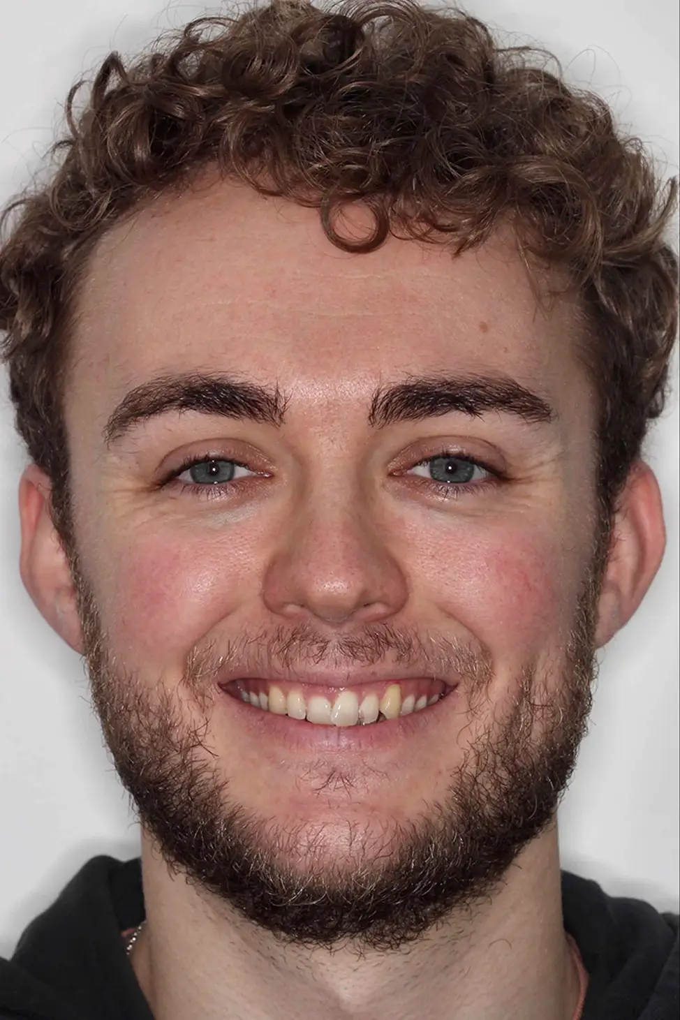 before and after photo of Invisalign, teeth whitening and SmileFast composite veneer treatment for adults