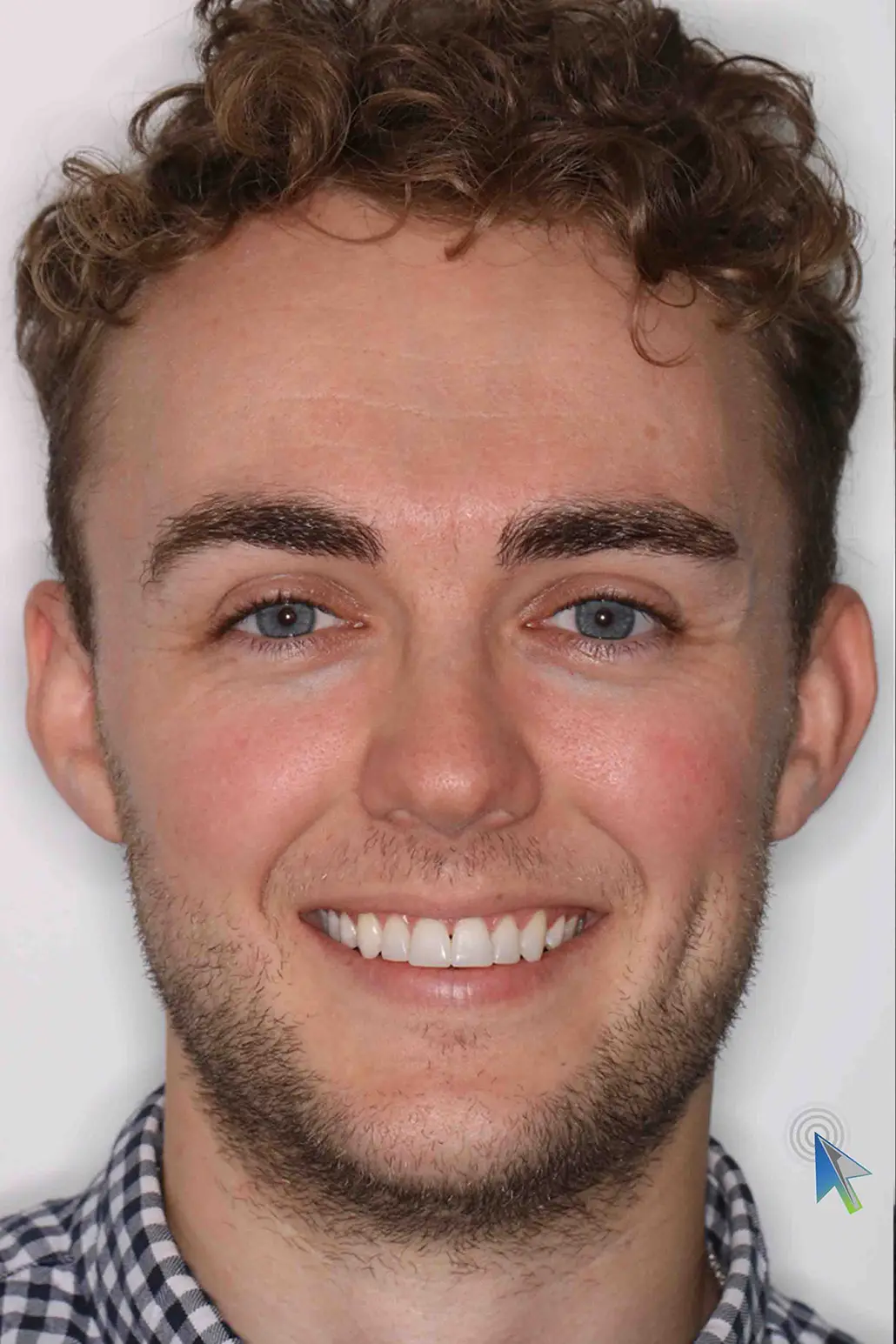 before and after photo of Invisalign, teeth whitening and SmileFast composite veneer treatment for adults