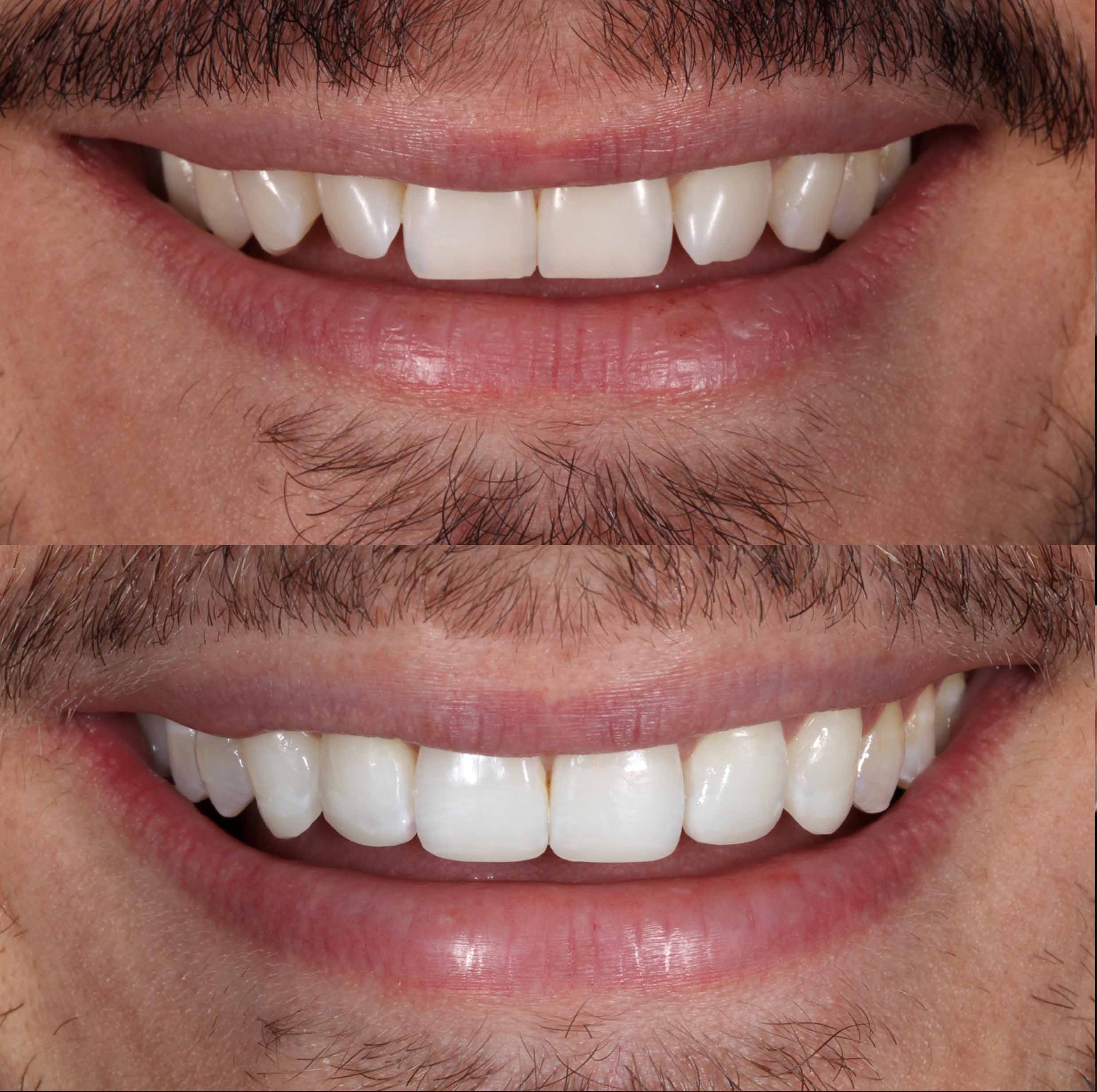 before and after photo of Invisalign, teeth whitening and composite edge bonding treatment for adults