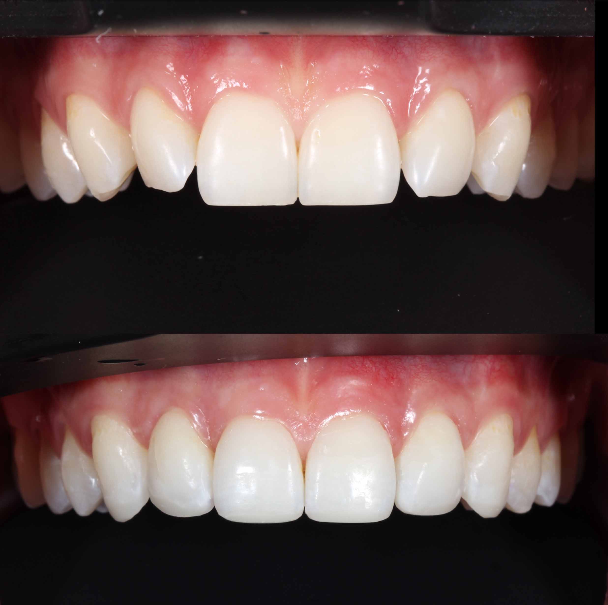 before and after photo of Invisalign, teeth whitening and composite edge bonding treatment for adults