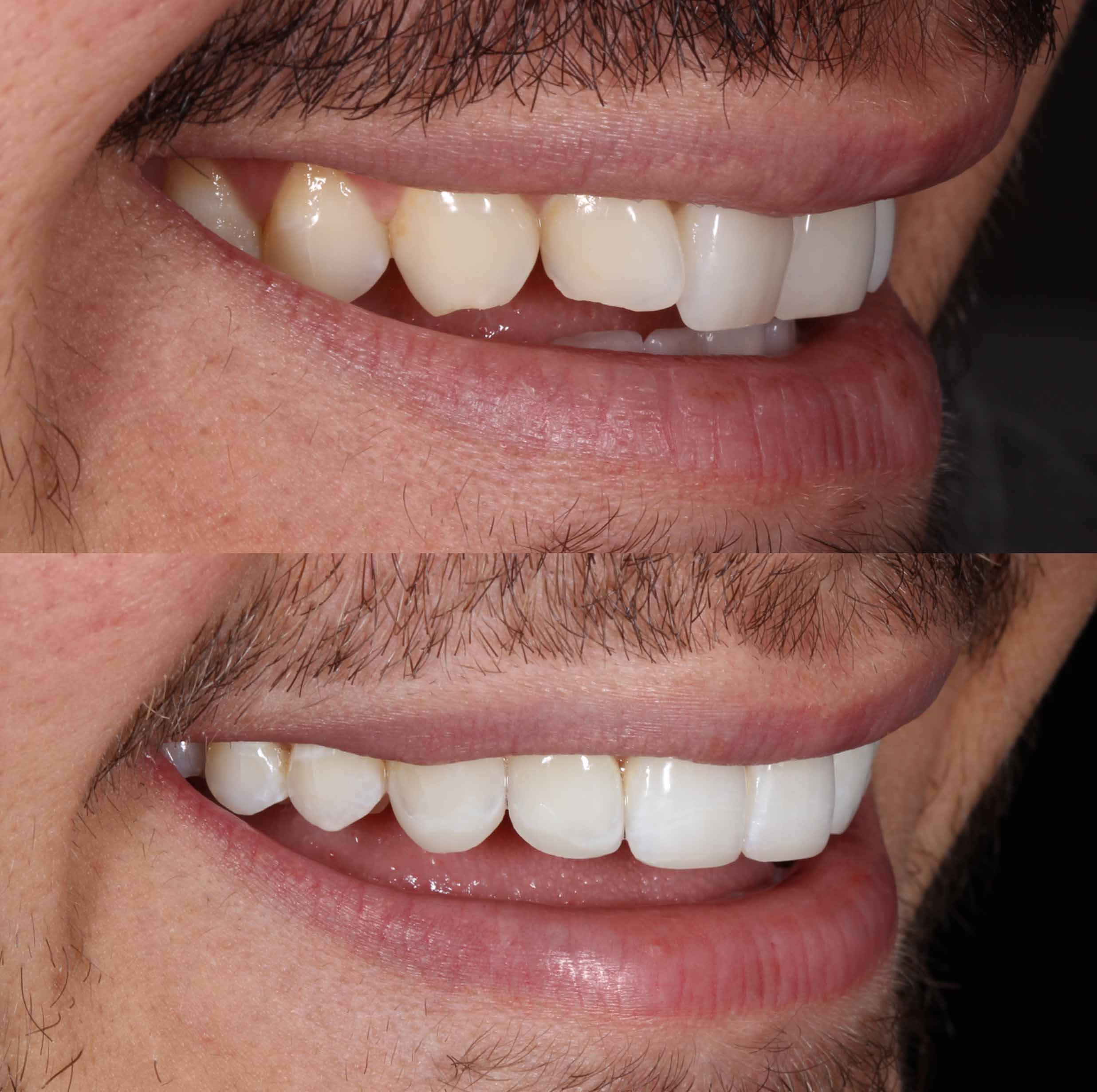 before and after photo of Invisalign, teeth whitening and composite edge bonding treatment for adults