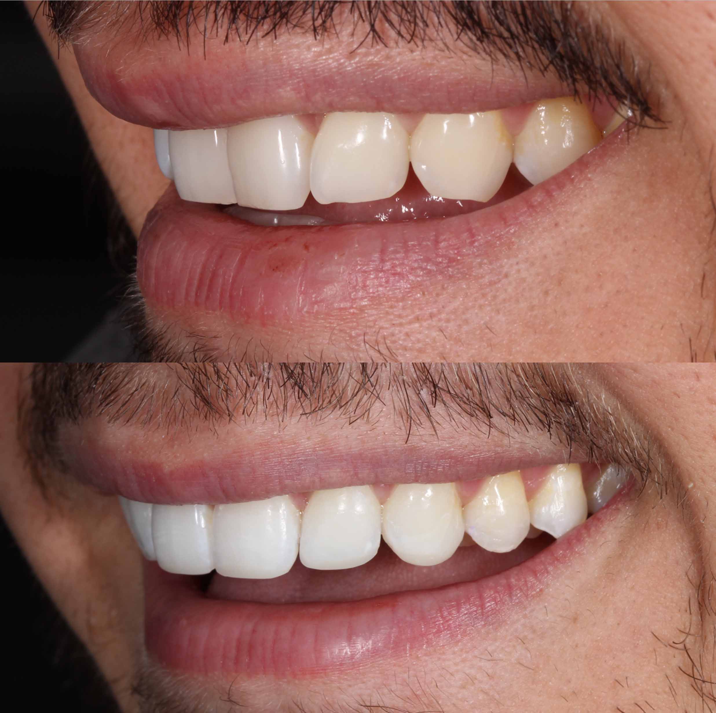 before and after photo of Invisalign, teeth whitening and composite edge bonding treatment for adults