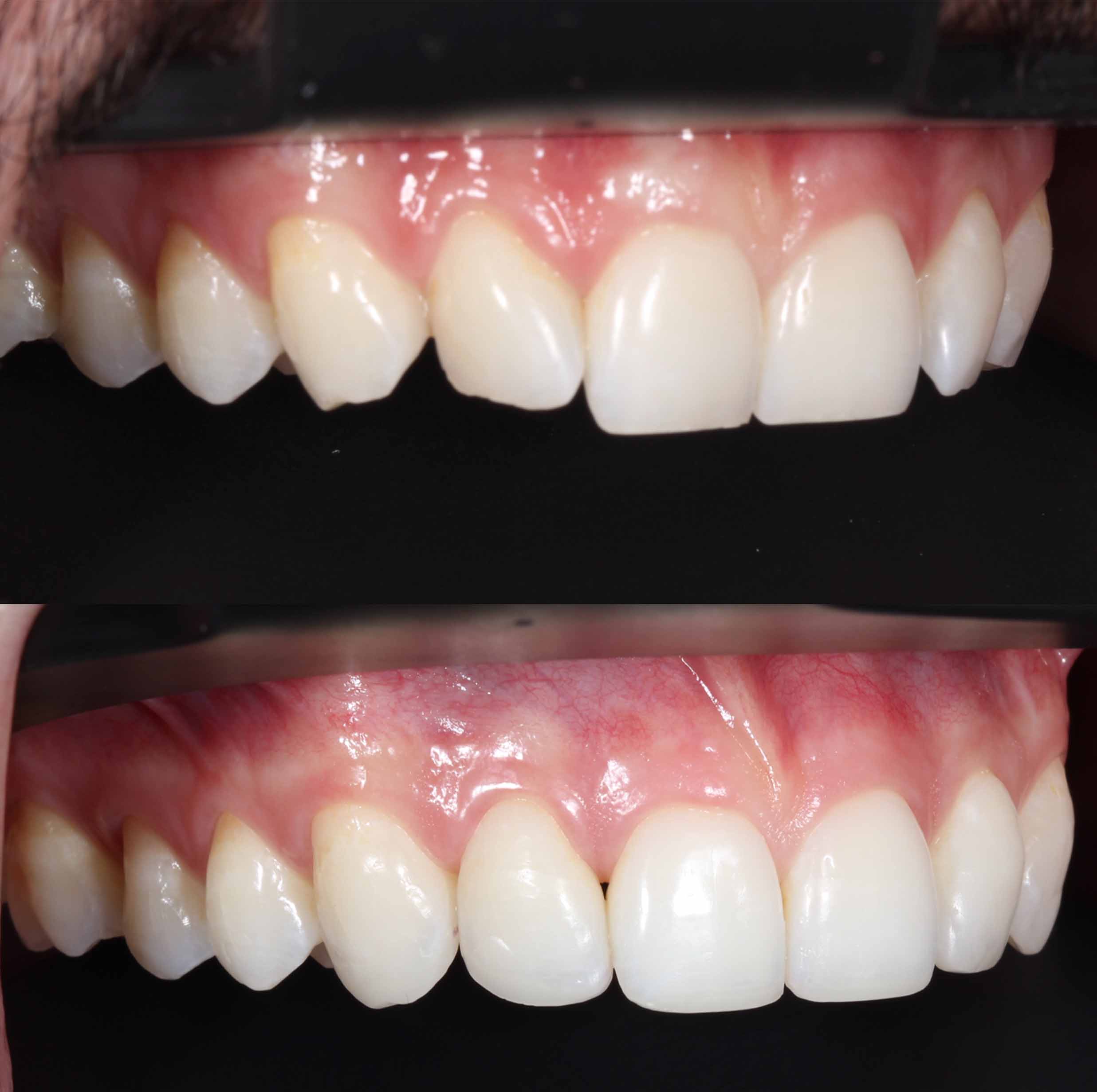 before and after photo of Invisalign, teeth whitening and composite edge bonding treatment for adults