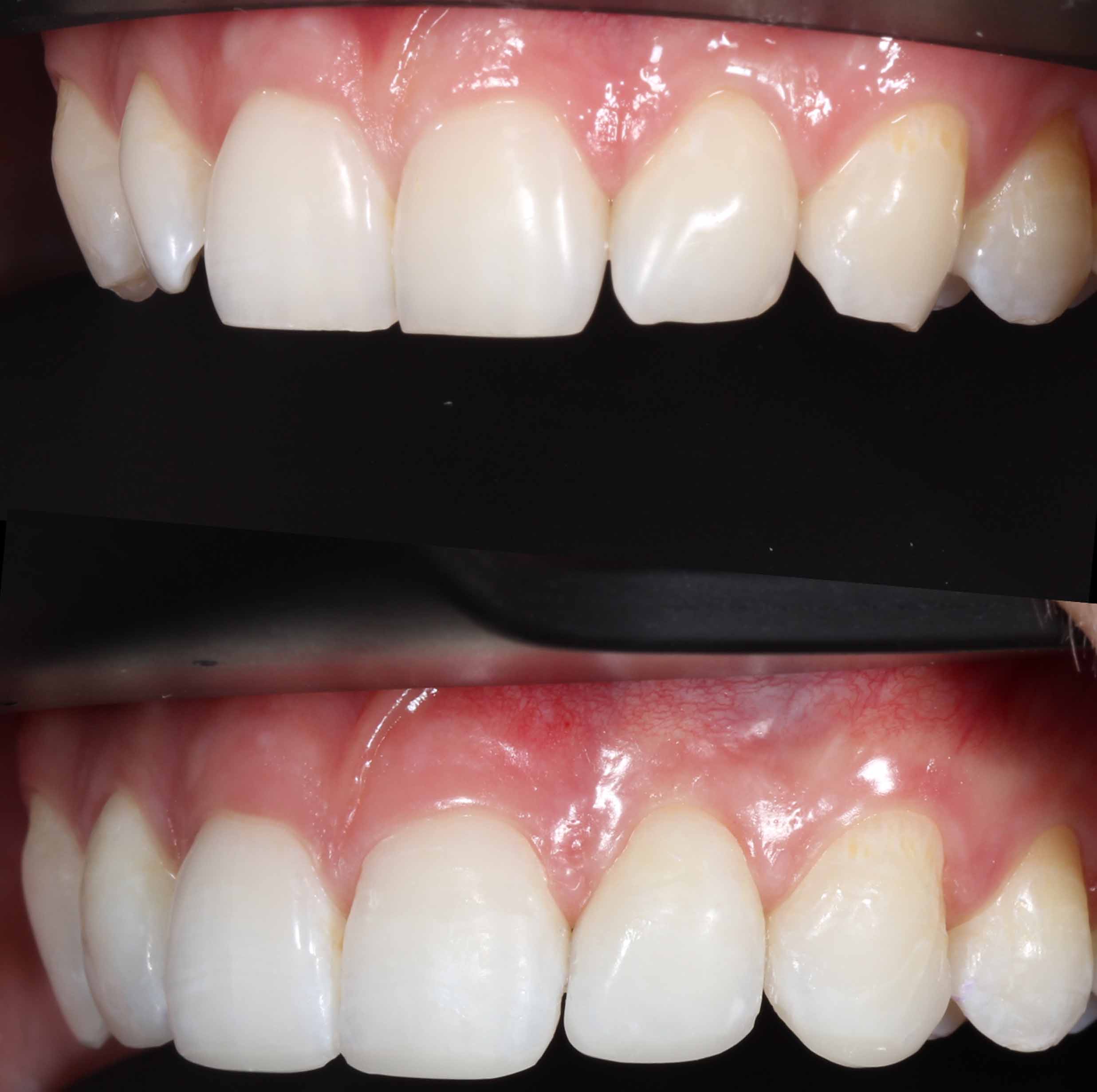 before and after photo of Invisalign, teeth whitening and composite edge bonding treatment for adults