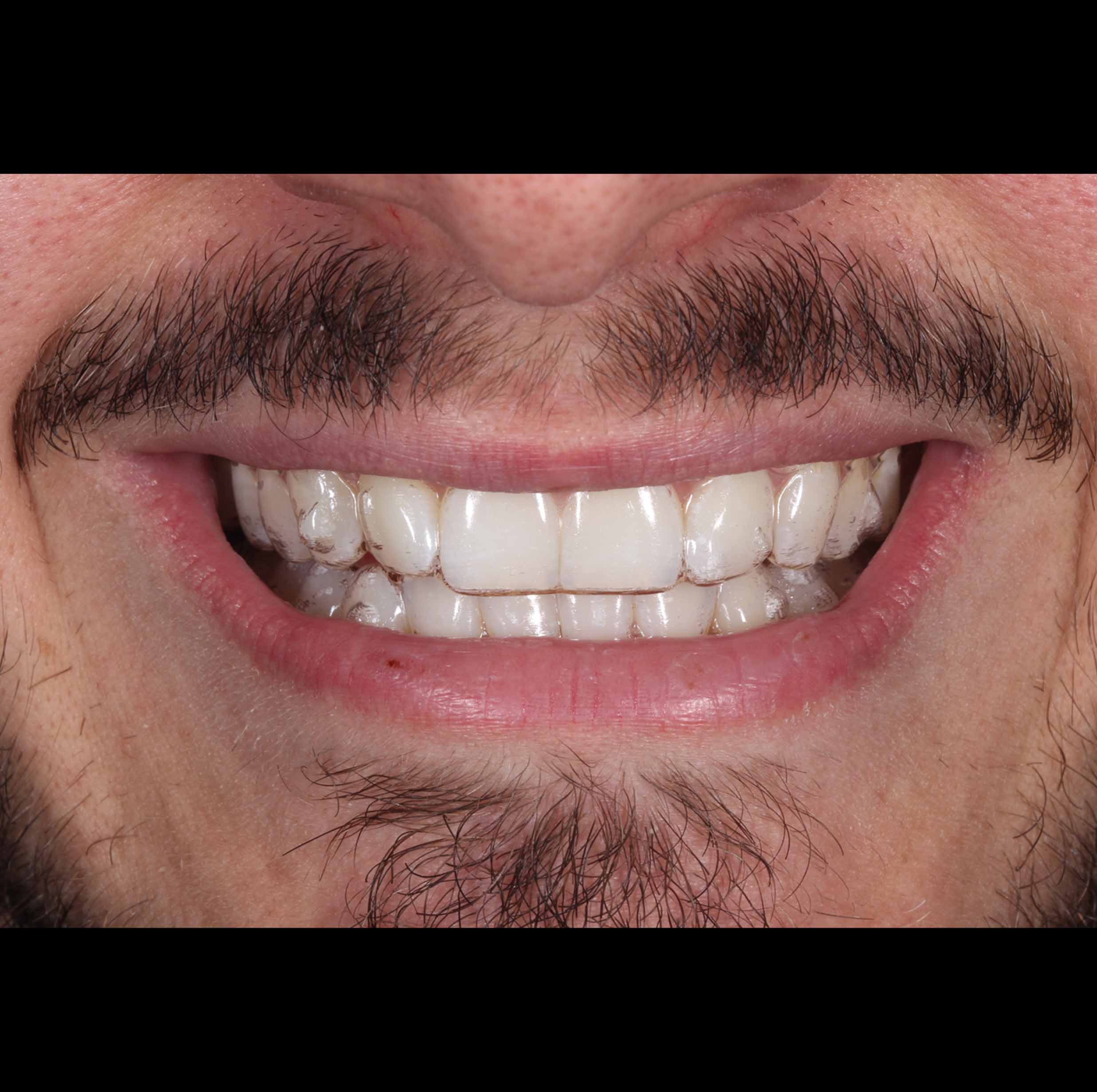 before and after photo of Invisalign, teeth whitening and composite edge bonding treatment for adults