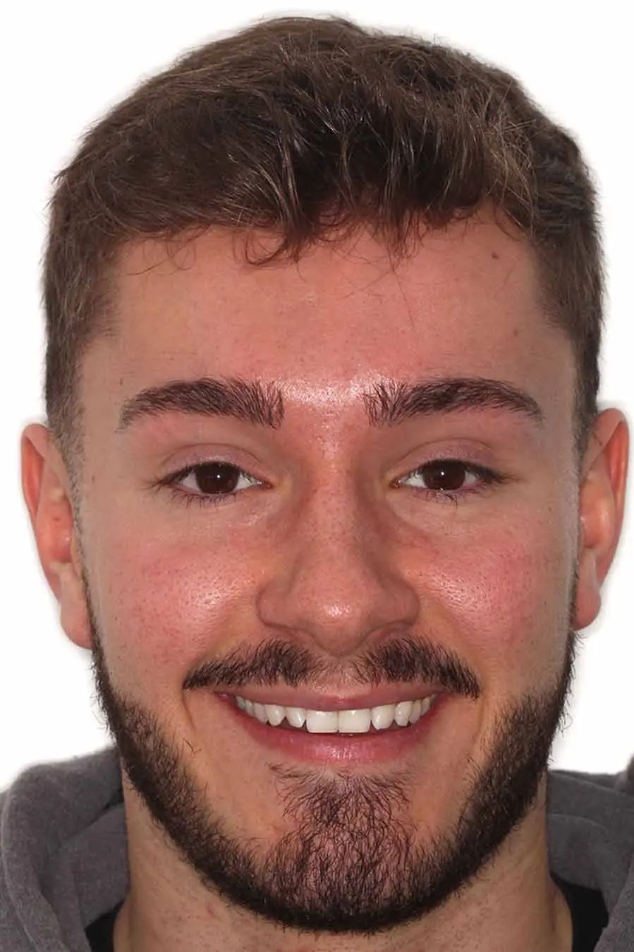 before and after photo of Invisalign, teeth whitening and composite edge bonding treatment for adults