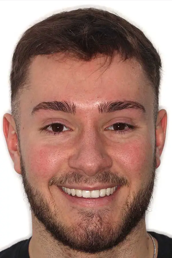 before and after photo of Invisalign, teeth whitening and composite edge bonding treatment for adults