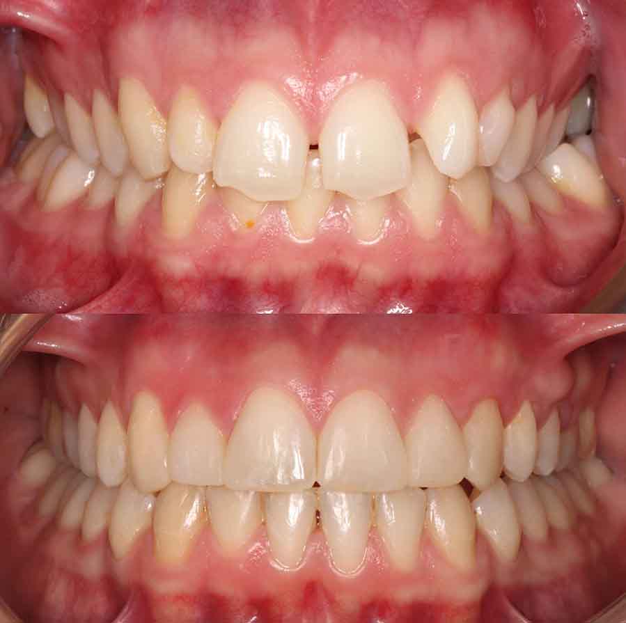 before and after photo of clear ceramic fixed braces treatment for adults