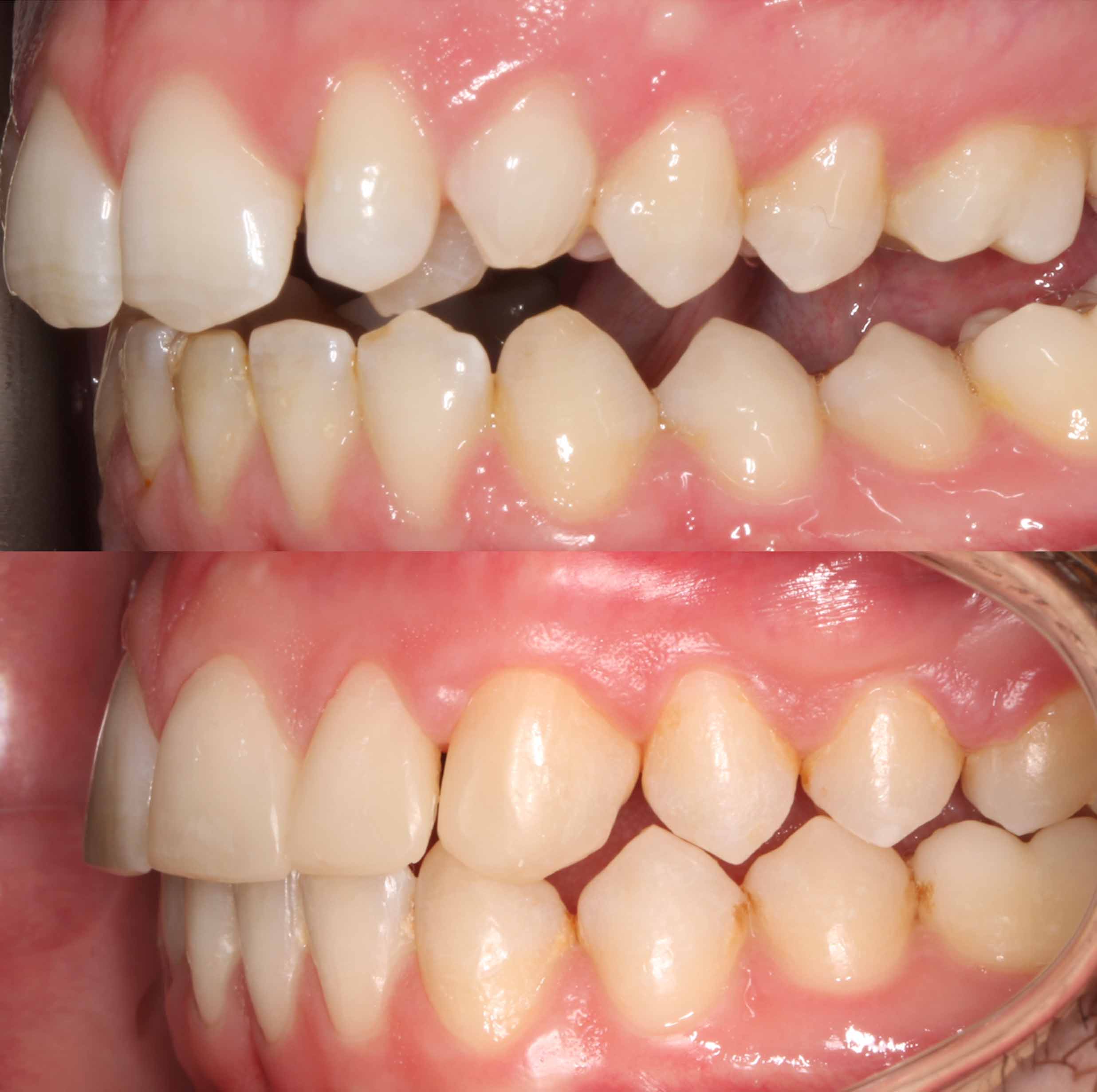 before and after photo of clear ceramic fixed braces treatment for adults