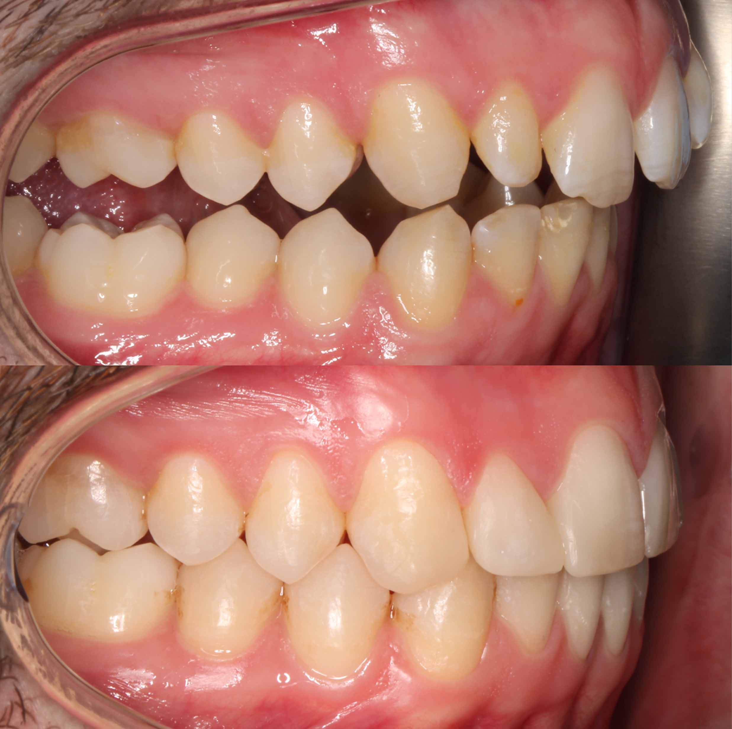 before and after photo of clear ceramic fixed braces treatment for adults