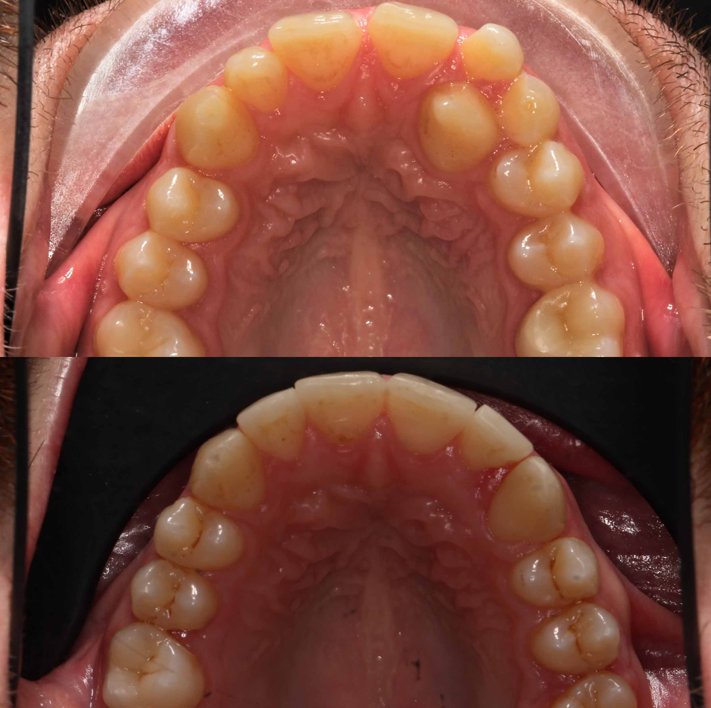before and after photo of clear ceramic fixed braces treatment for adults