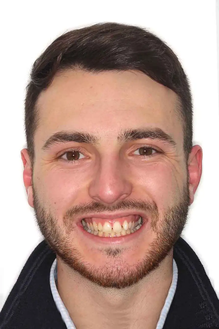 before and after photo of clear ceramic fixed braces treatment for adults