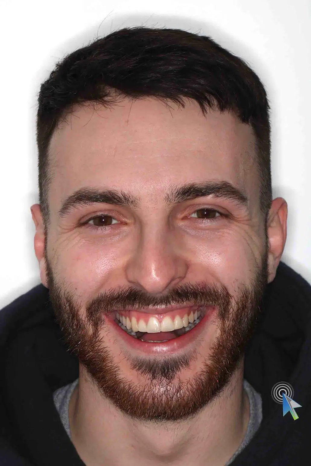 before and after photo of clear ceramic fixed braces treatment for adults