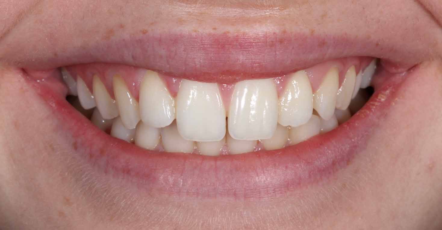Child patient smiling before Invisalign treatment